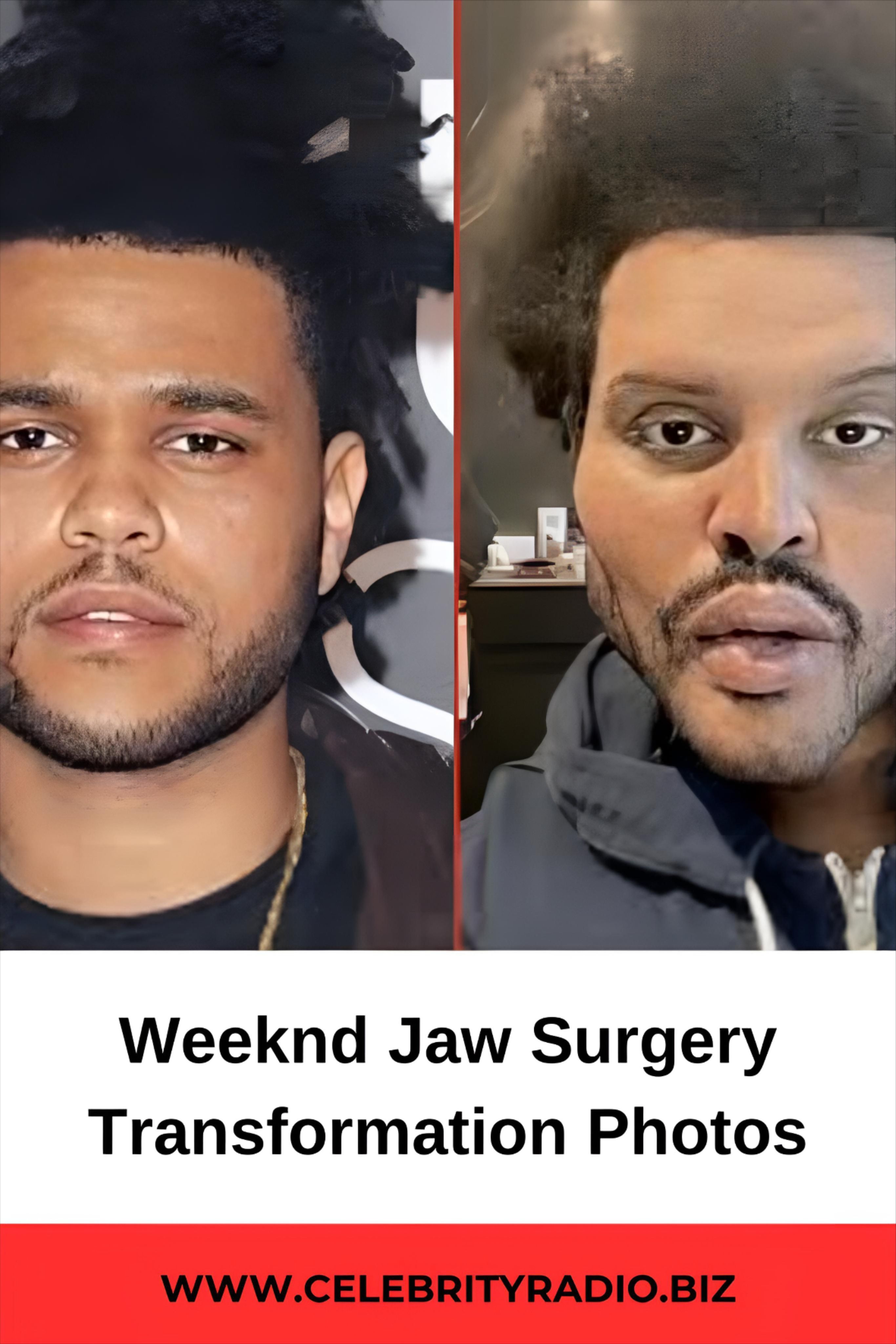 Weeknd Face Surgery