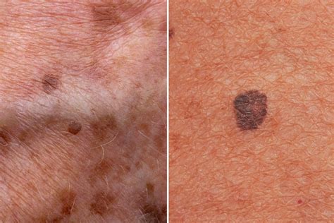 What Are Age Spots