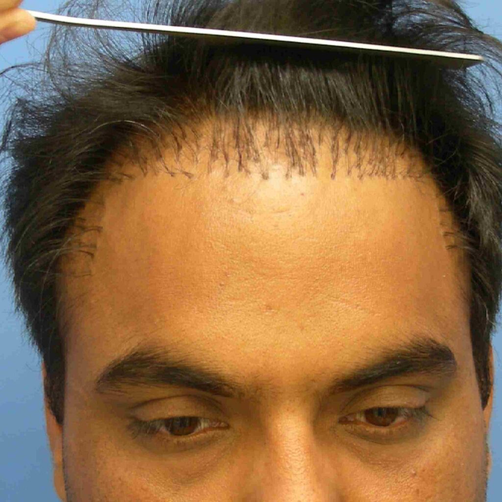 What Are Hair Plugs