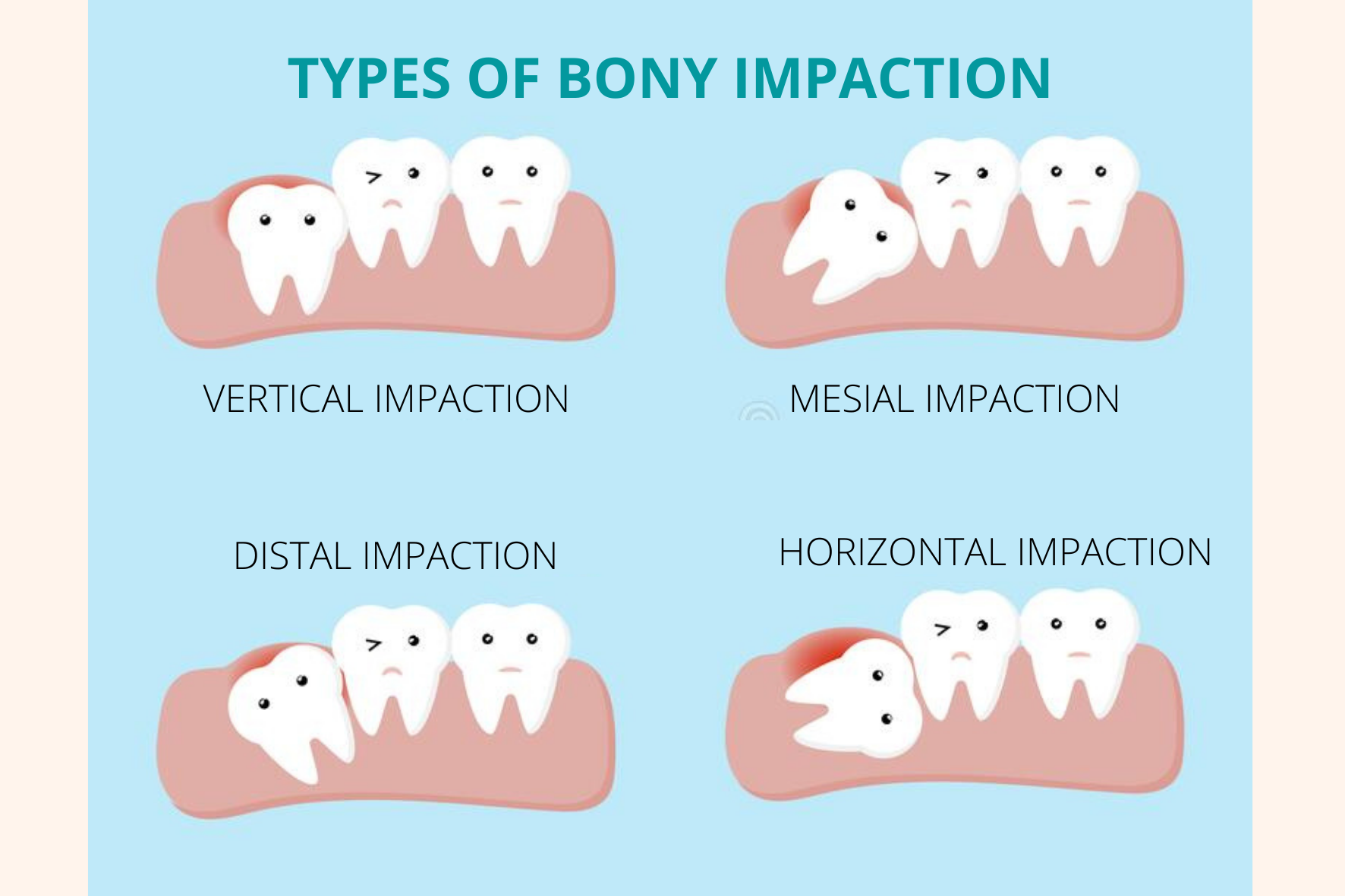 What Are Impacted Wisdom Teeth