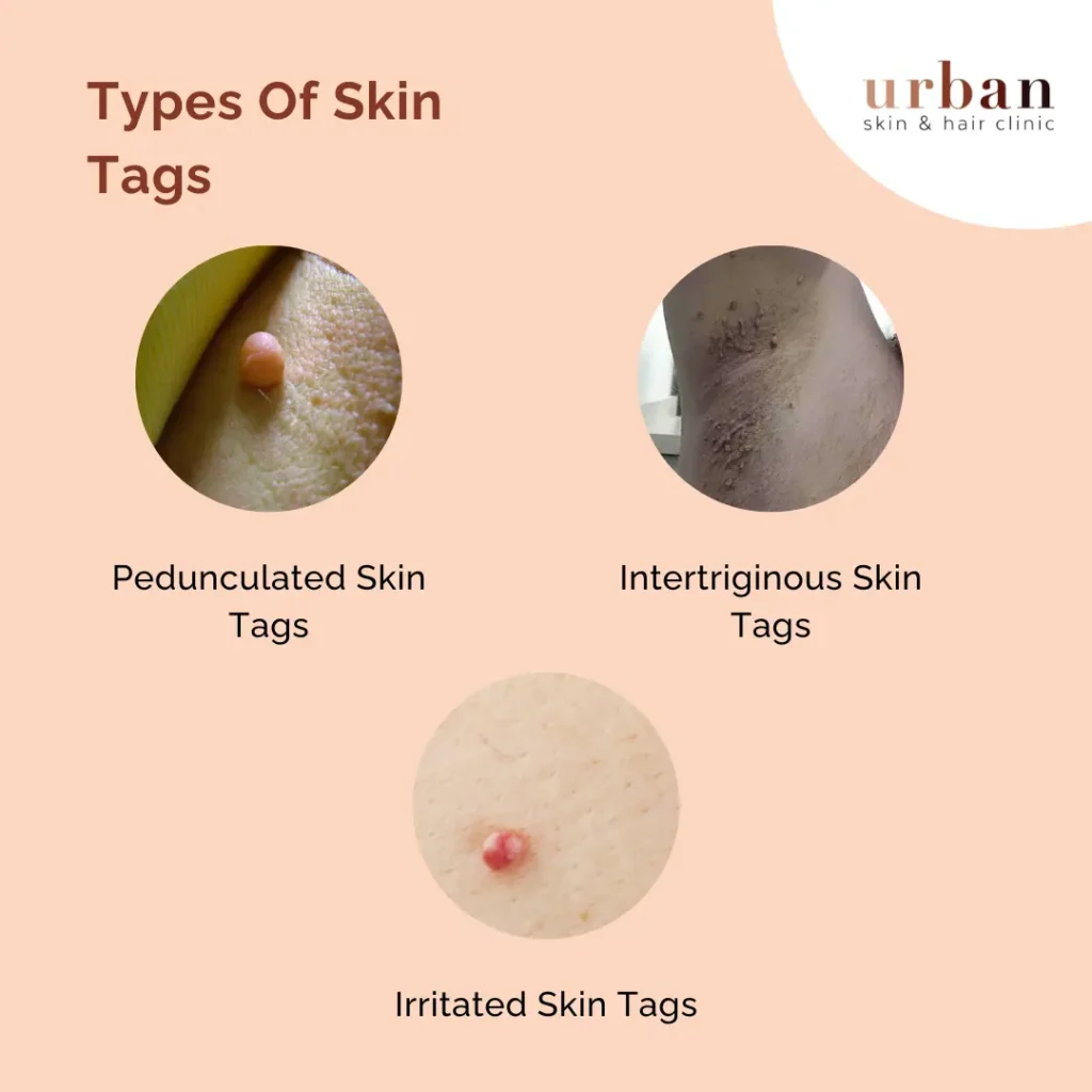 What Are Skin Tags