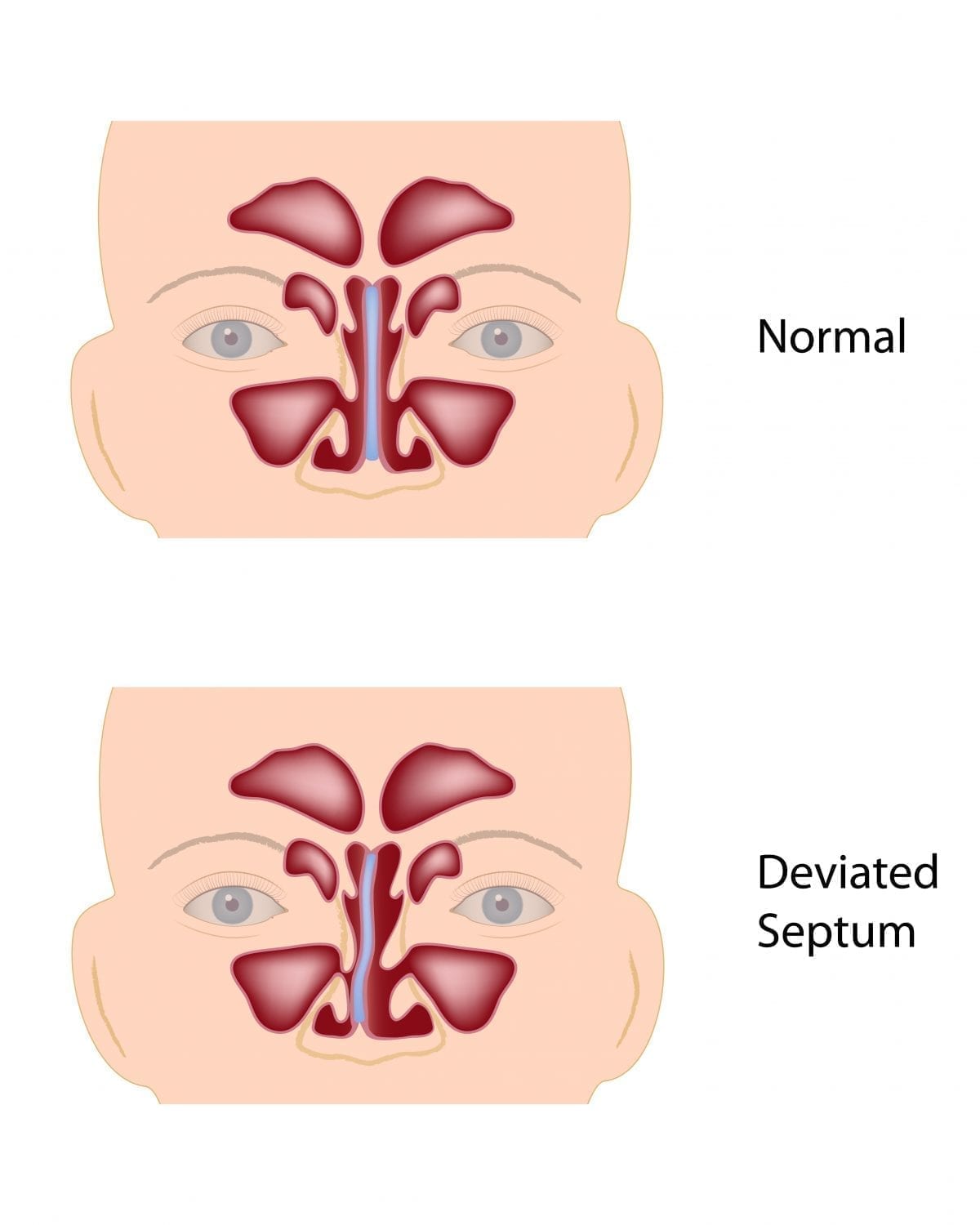 What Causes A Deviated Septum