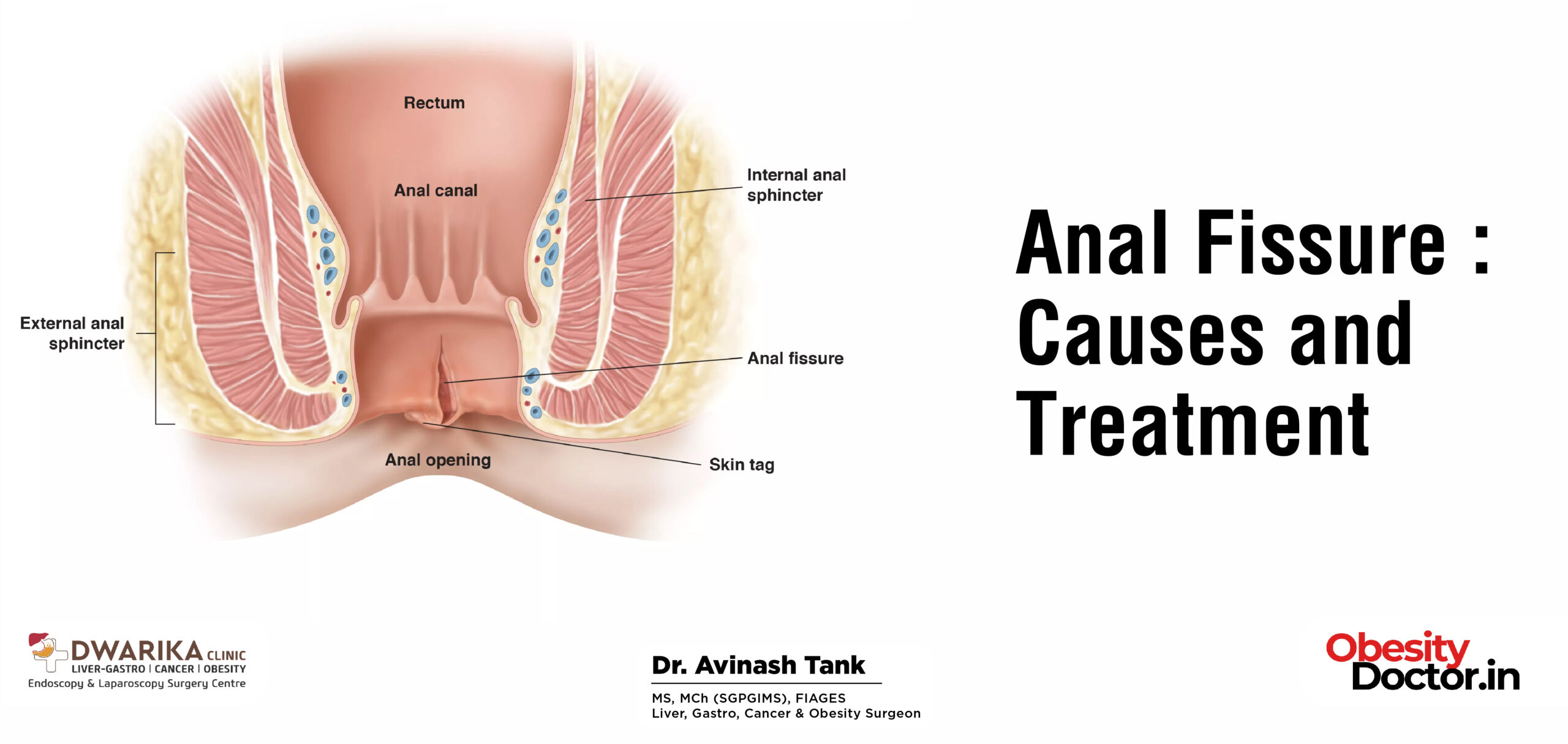 What Causes Anal Fissures