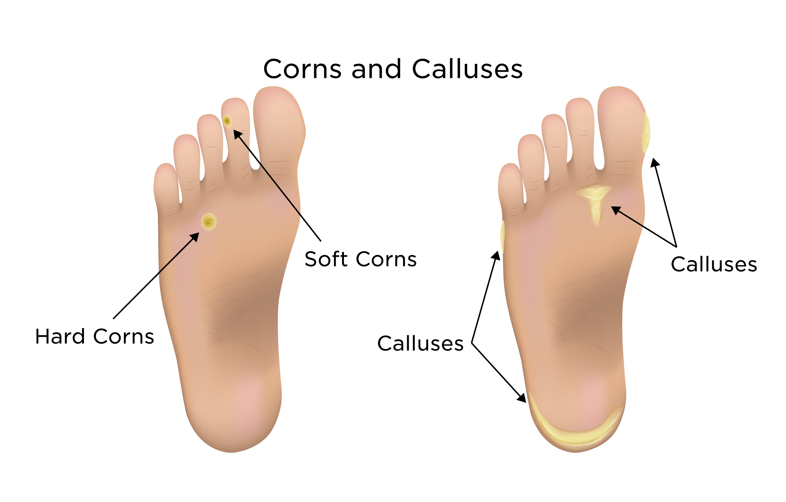 What Causes Calluses Feet
