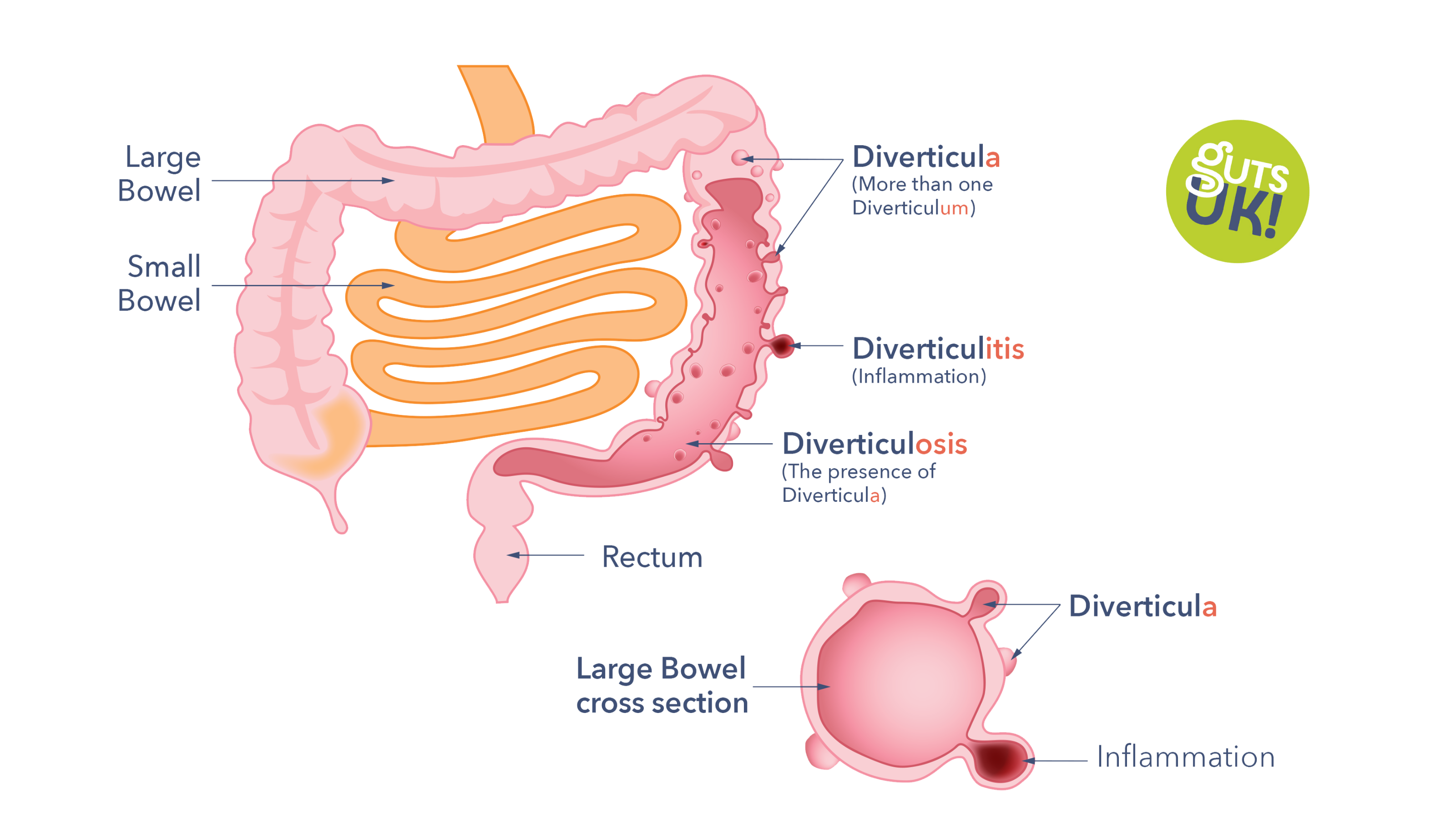What Causes Diverticulitis