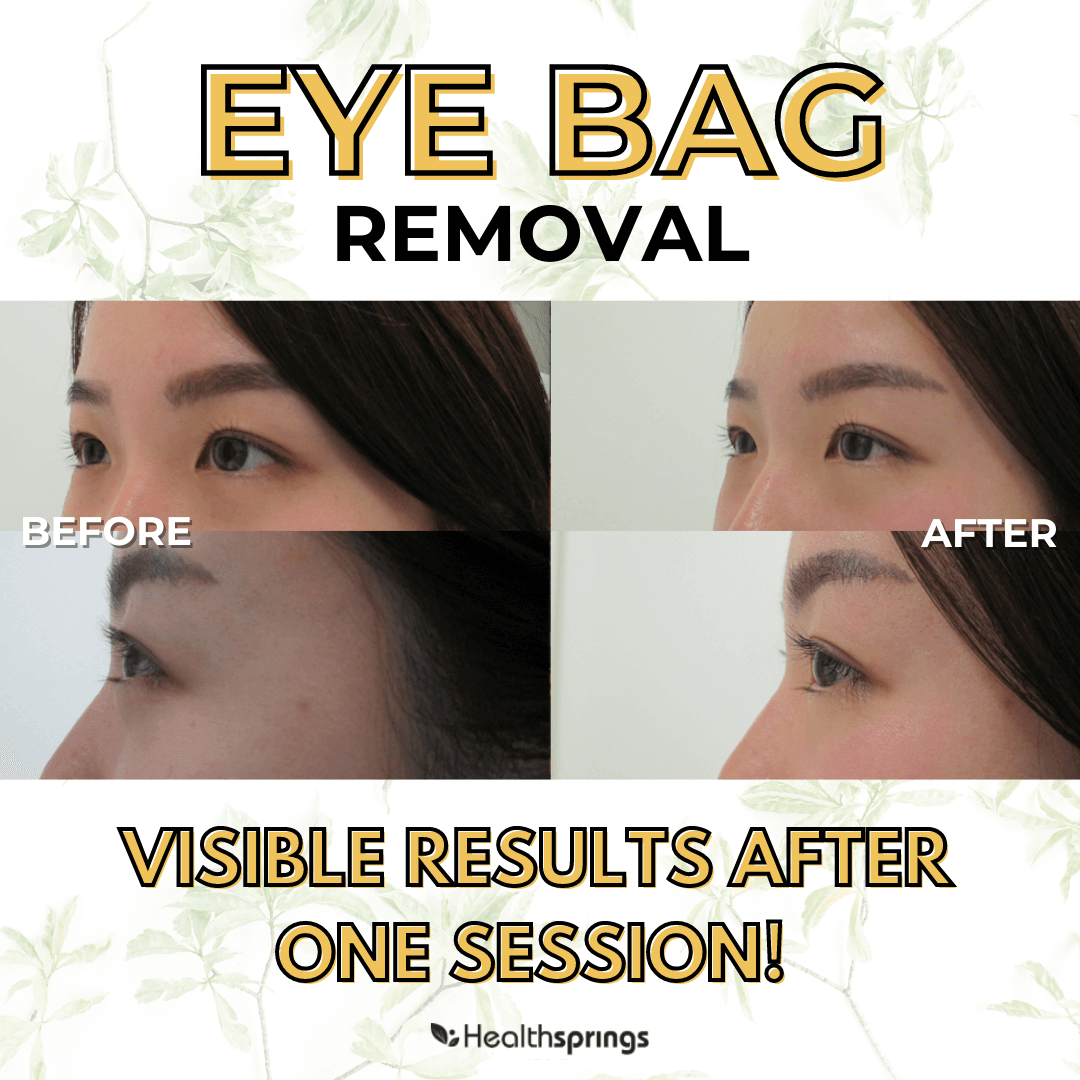 What Causes Eye Bags