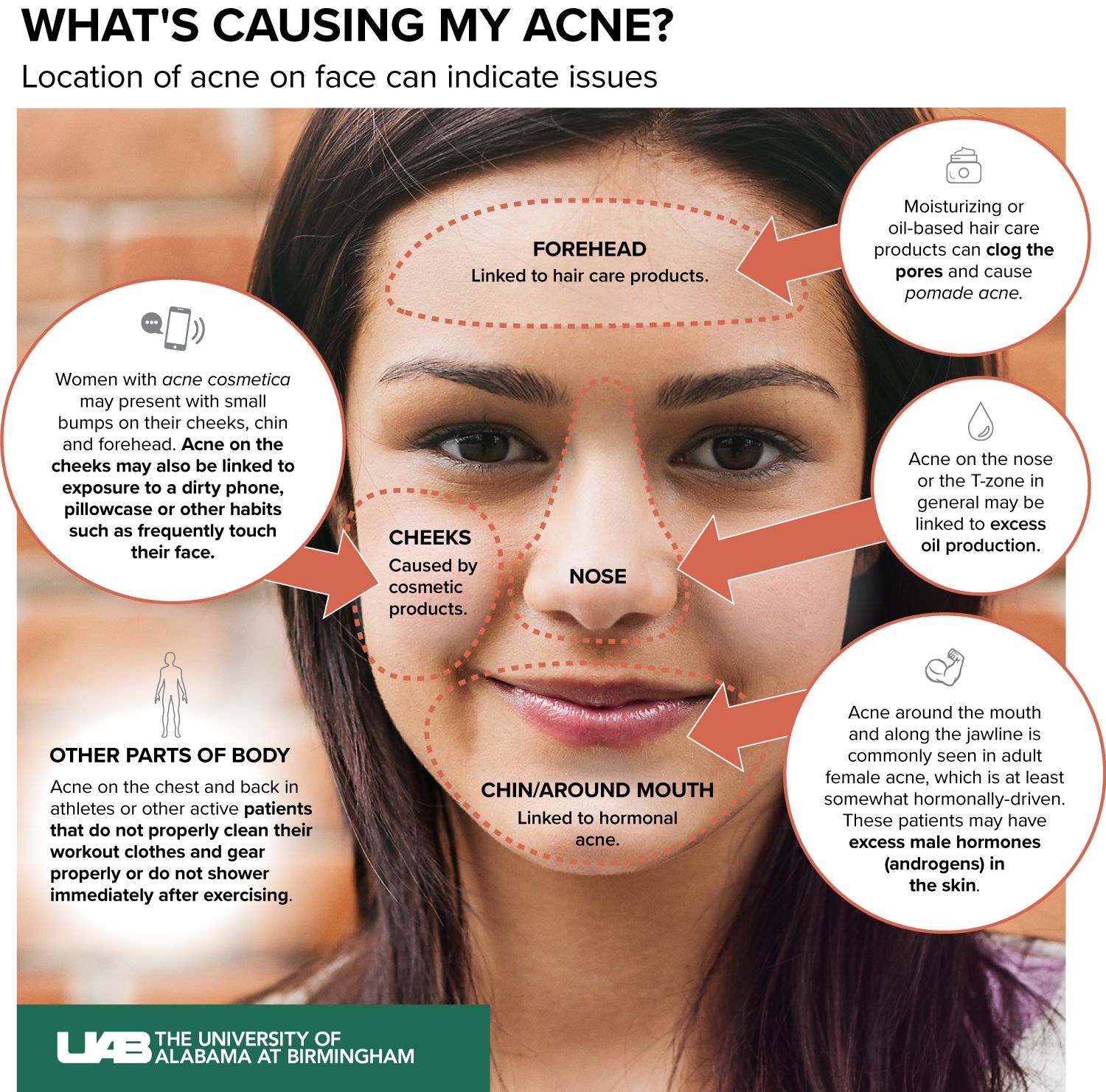 What Causes Forehead Acne
