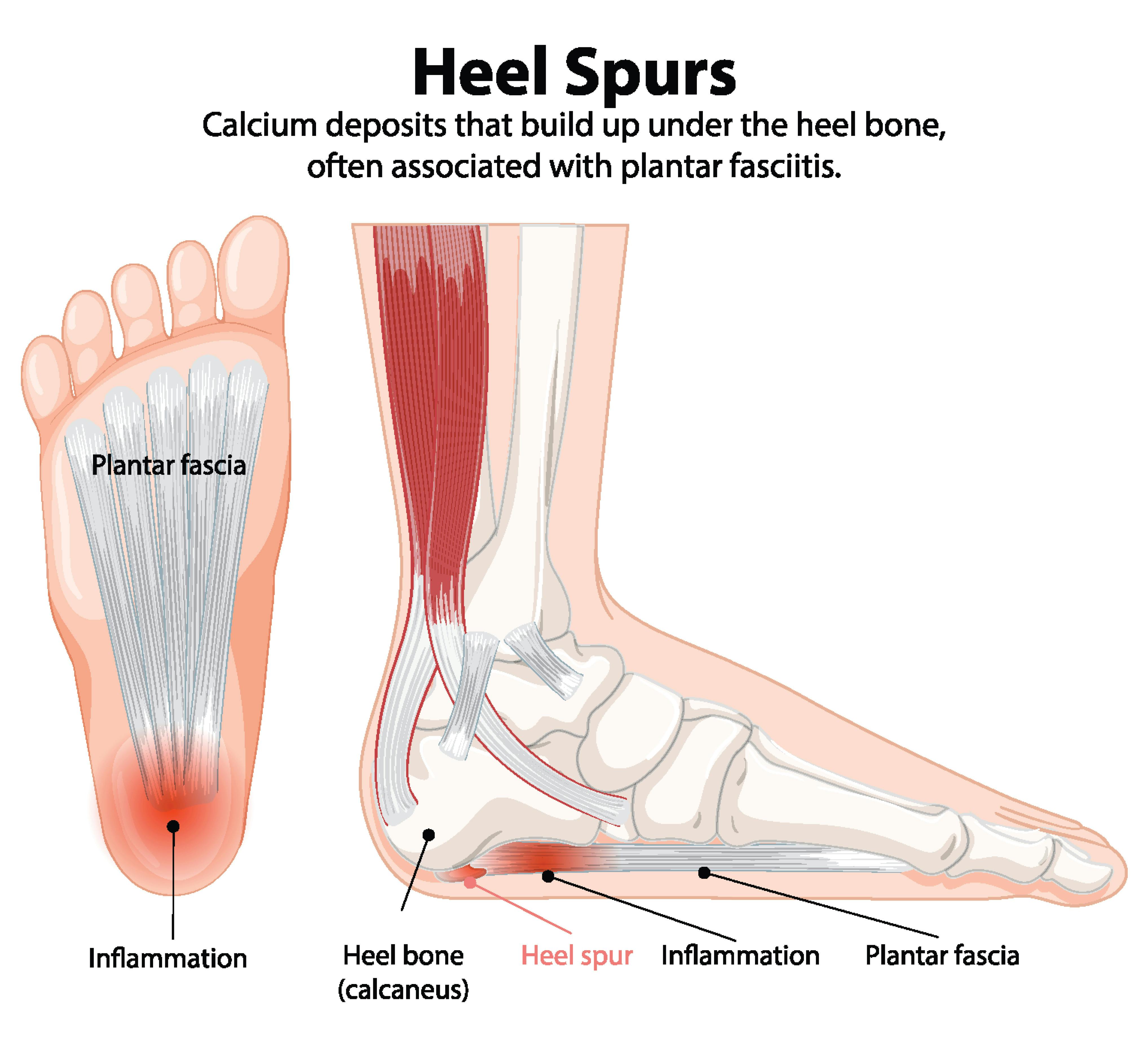 What Causes Heel Spurs