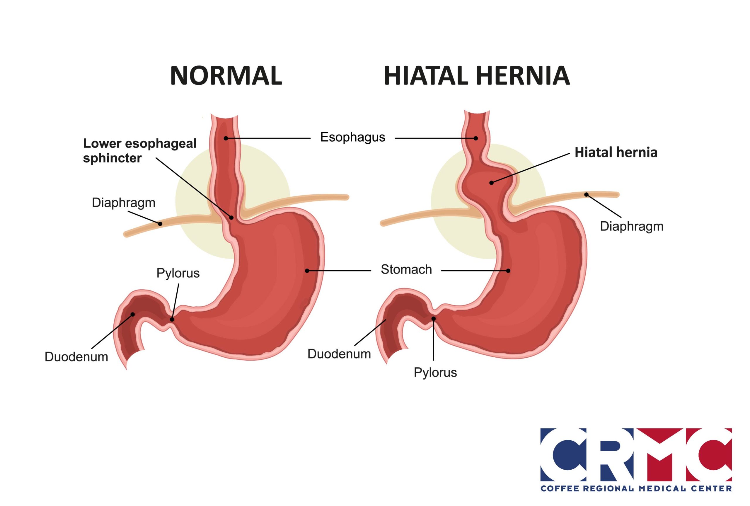 What Causes Hiatal Hernia