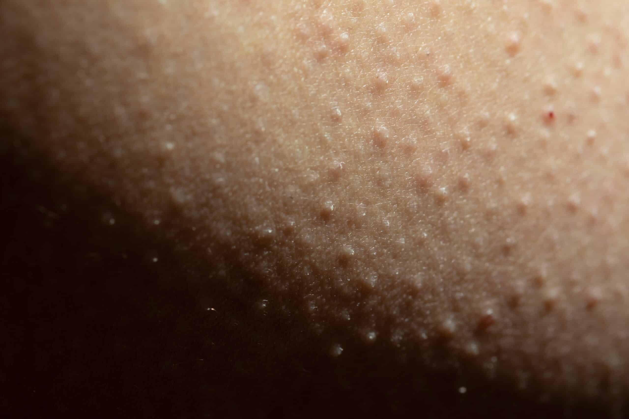 What Causes Keratosis Pilaris