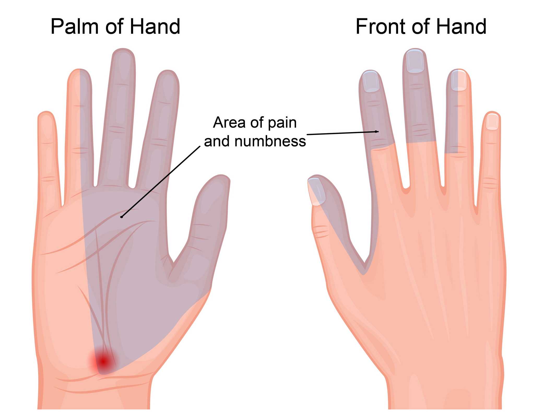 What Causes Numbness In Hands