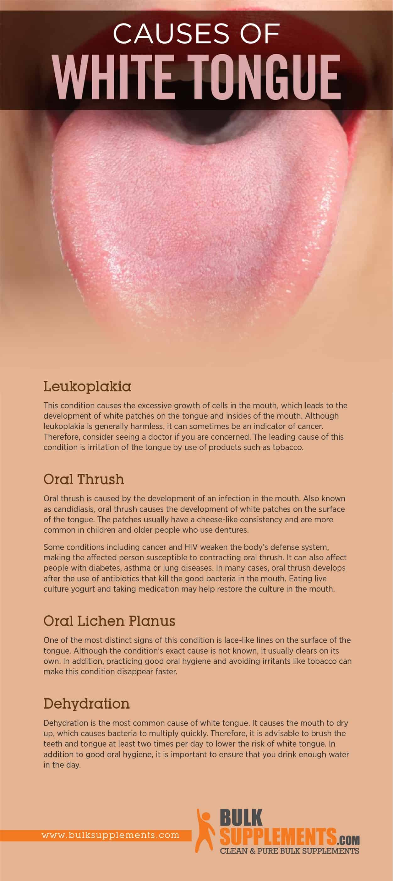 What Causes Of White Tongue