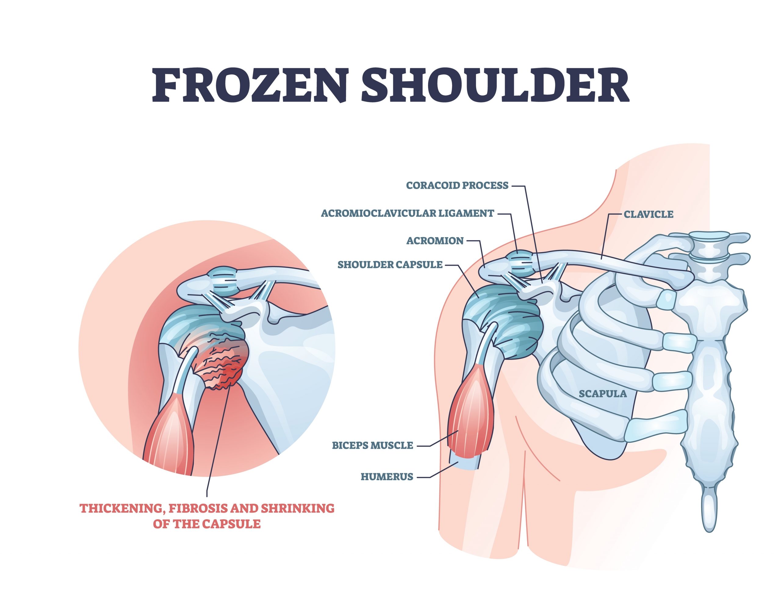 What Causes Shoulder Freeze