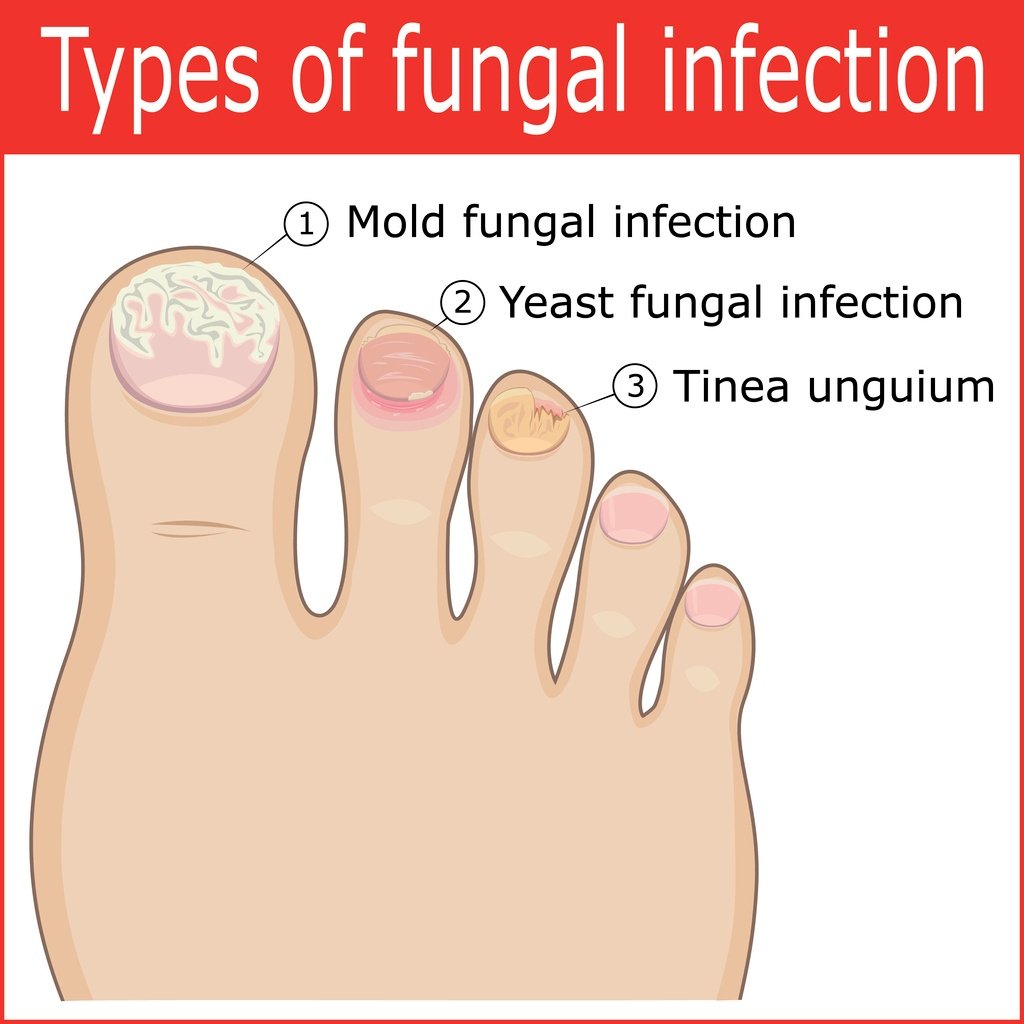 What Causes Toenail Fungus