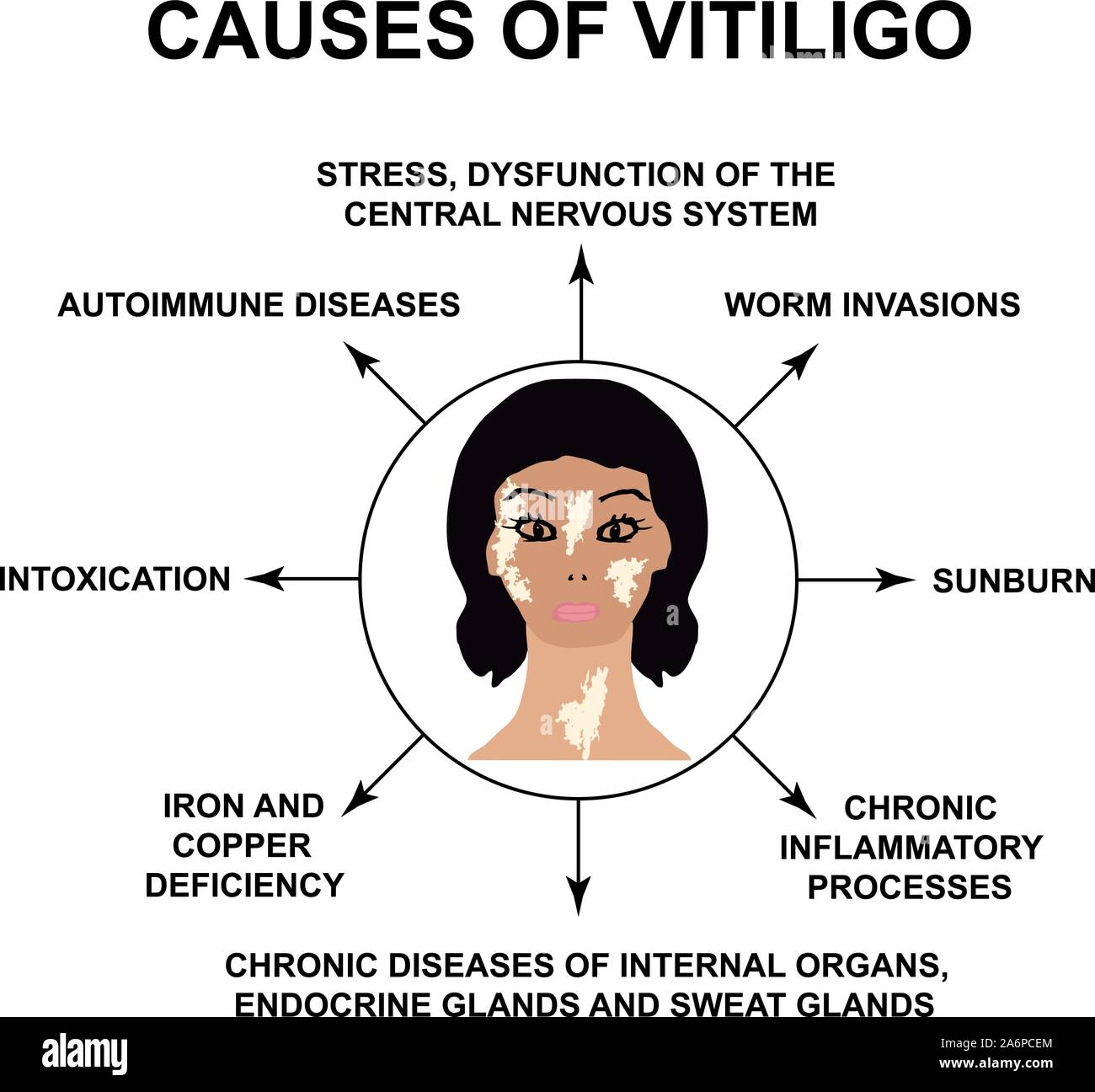 What Causes Vitiligo Disease