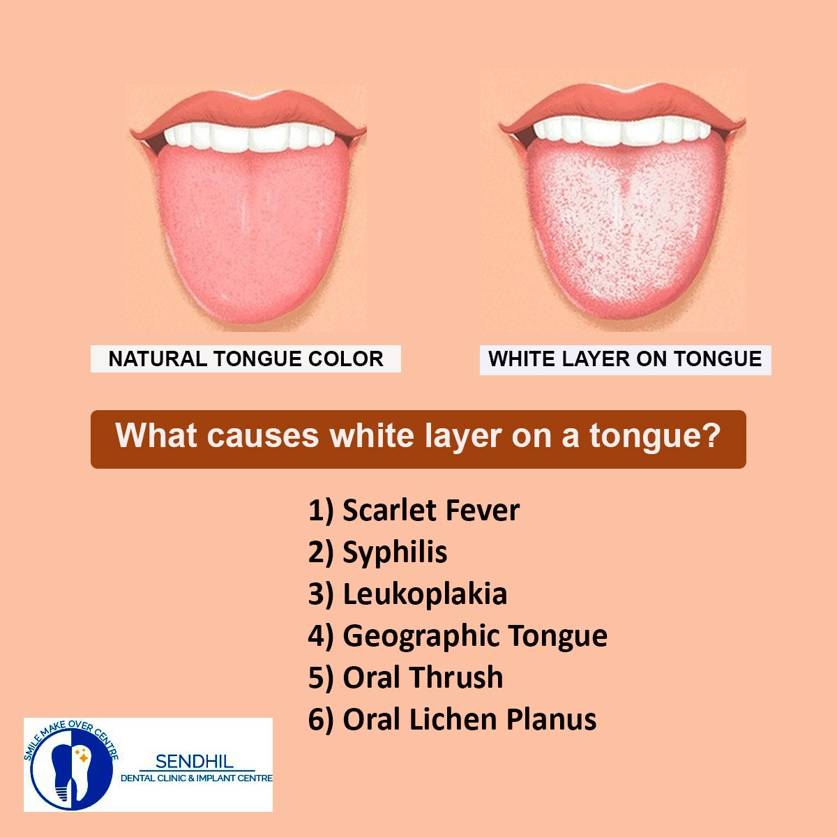 What Causes Whitish Tongue
