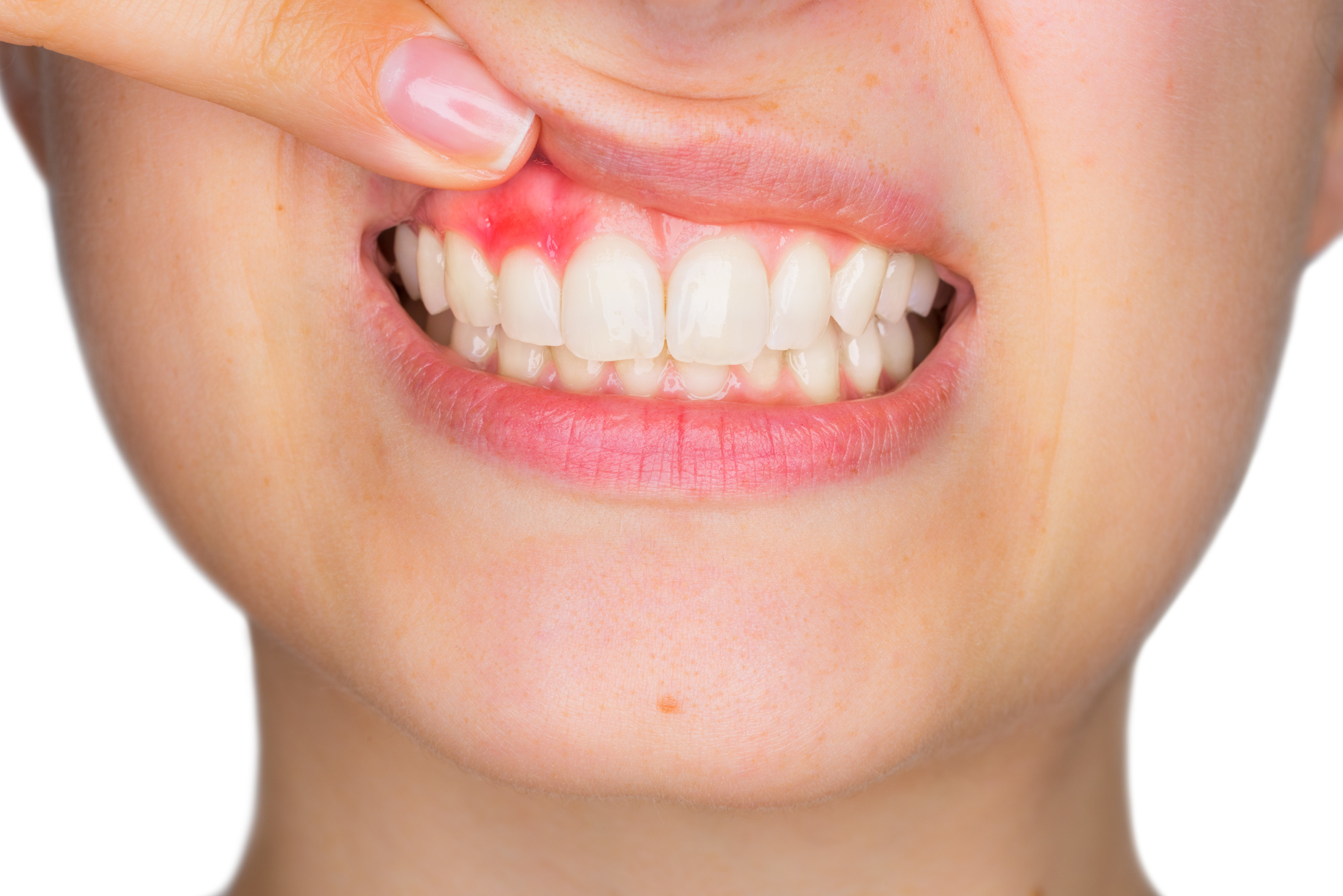 What Deficiency Causes Bleeding Gums