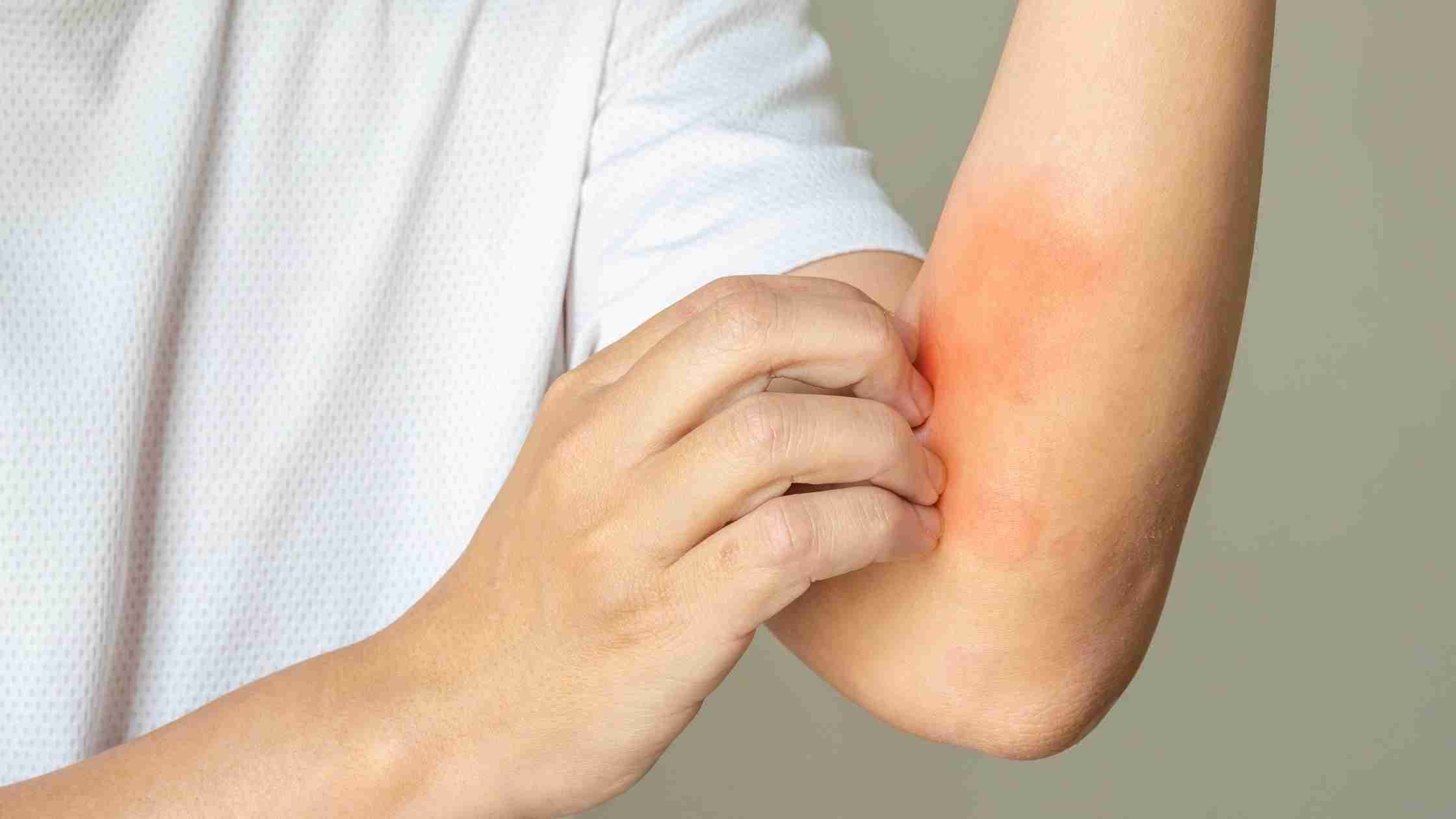 What Deficiency Causes Skin Itching