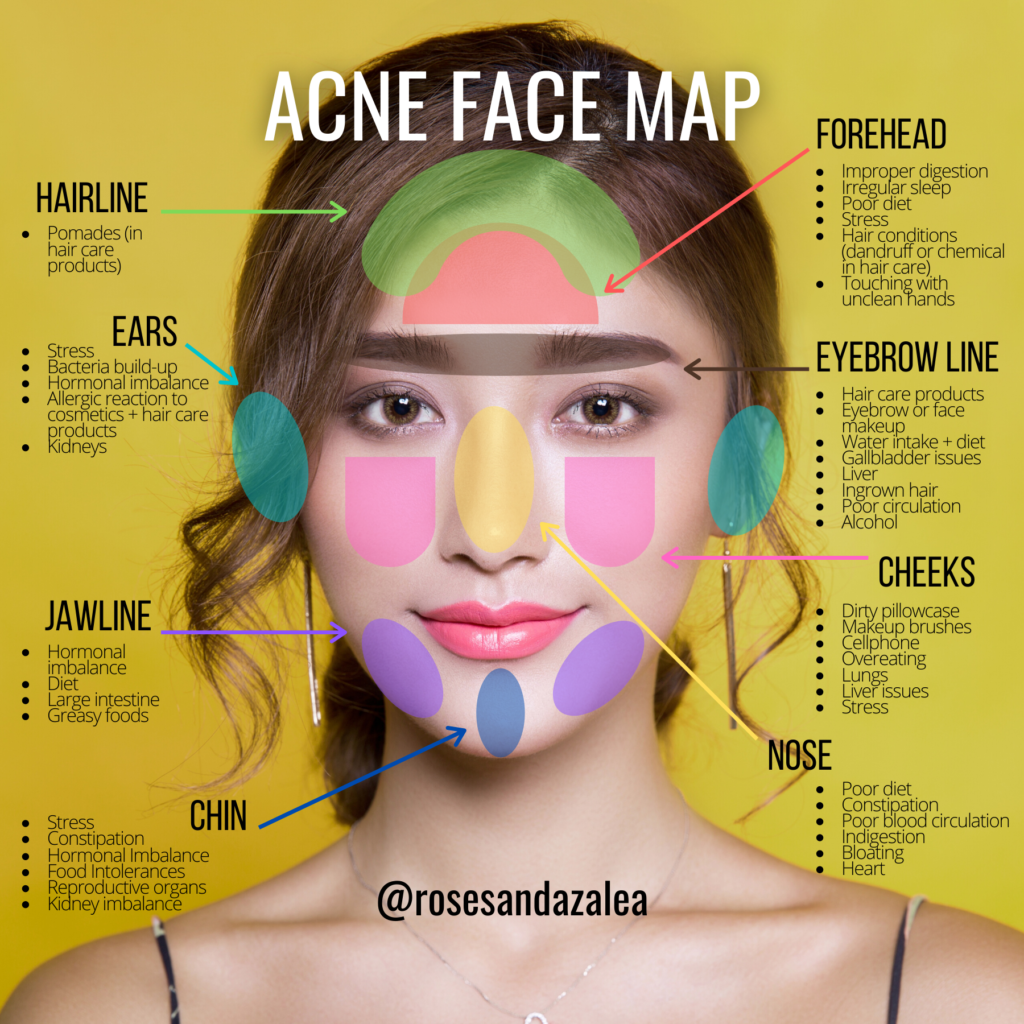What Does Chin Acne Mean