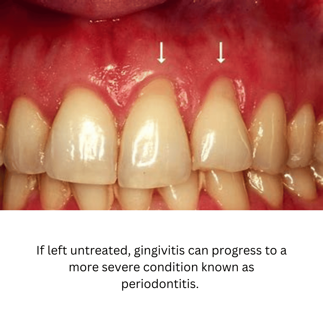 What Does Gingivitis Look Like