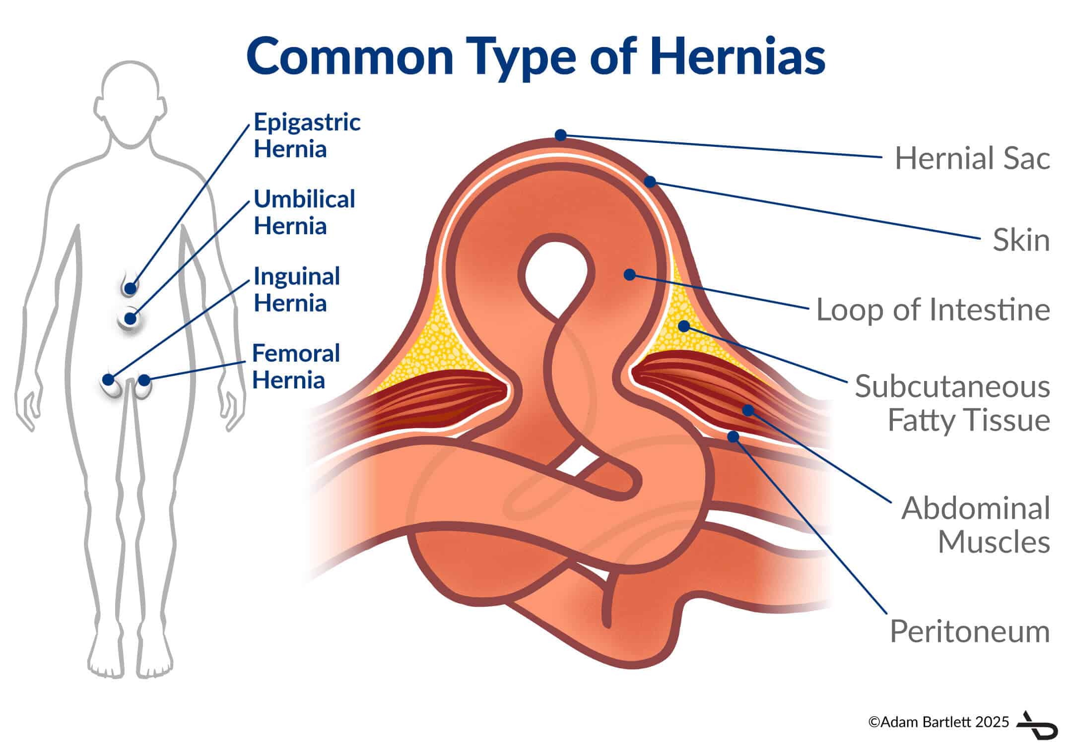 What Does Hernia Feel Like Groin