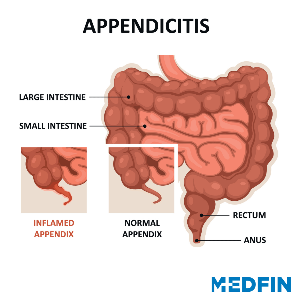 What Does It Feel Like Appendix Burst