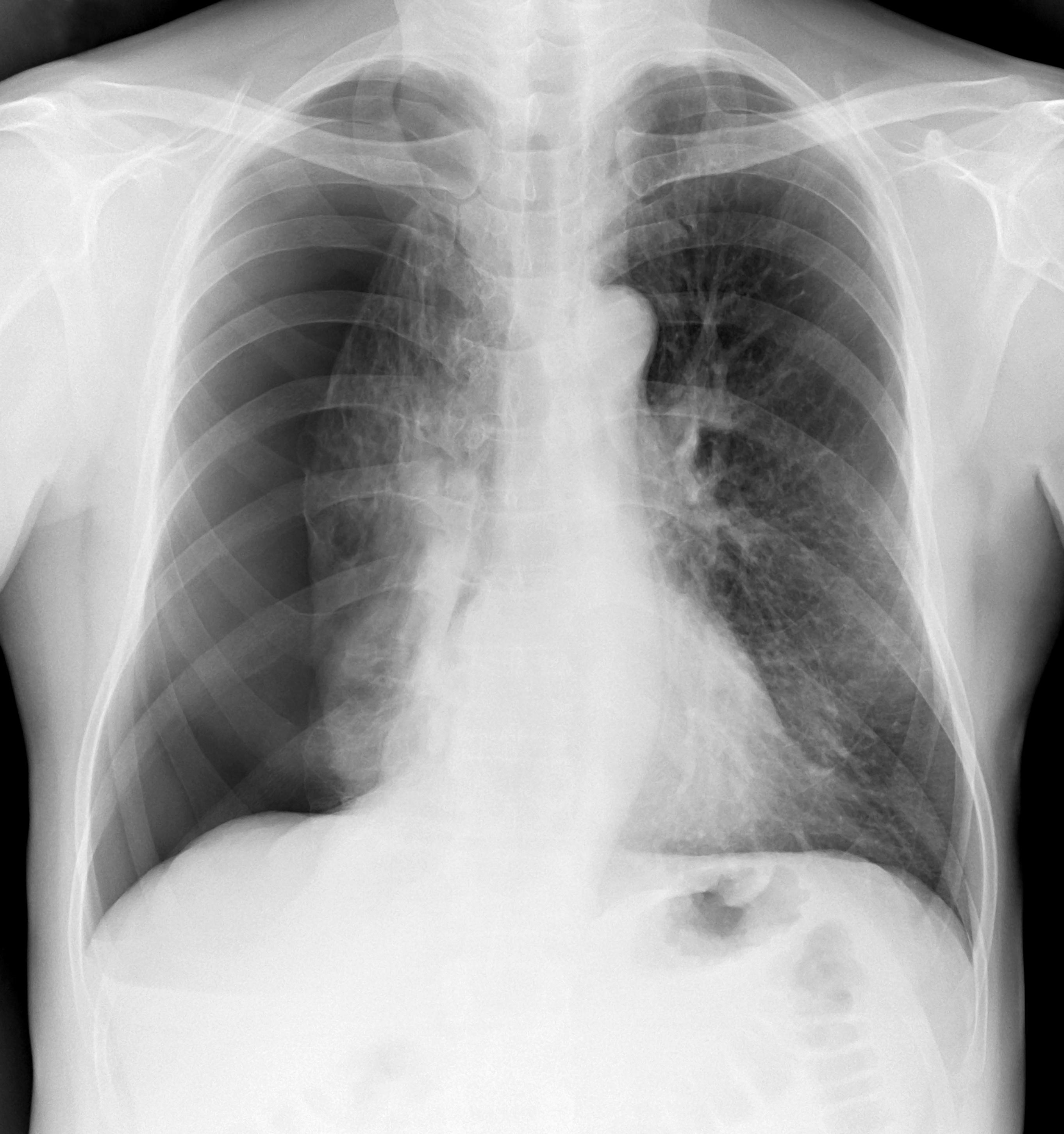 What Does It Feel Like Collapsed Lung