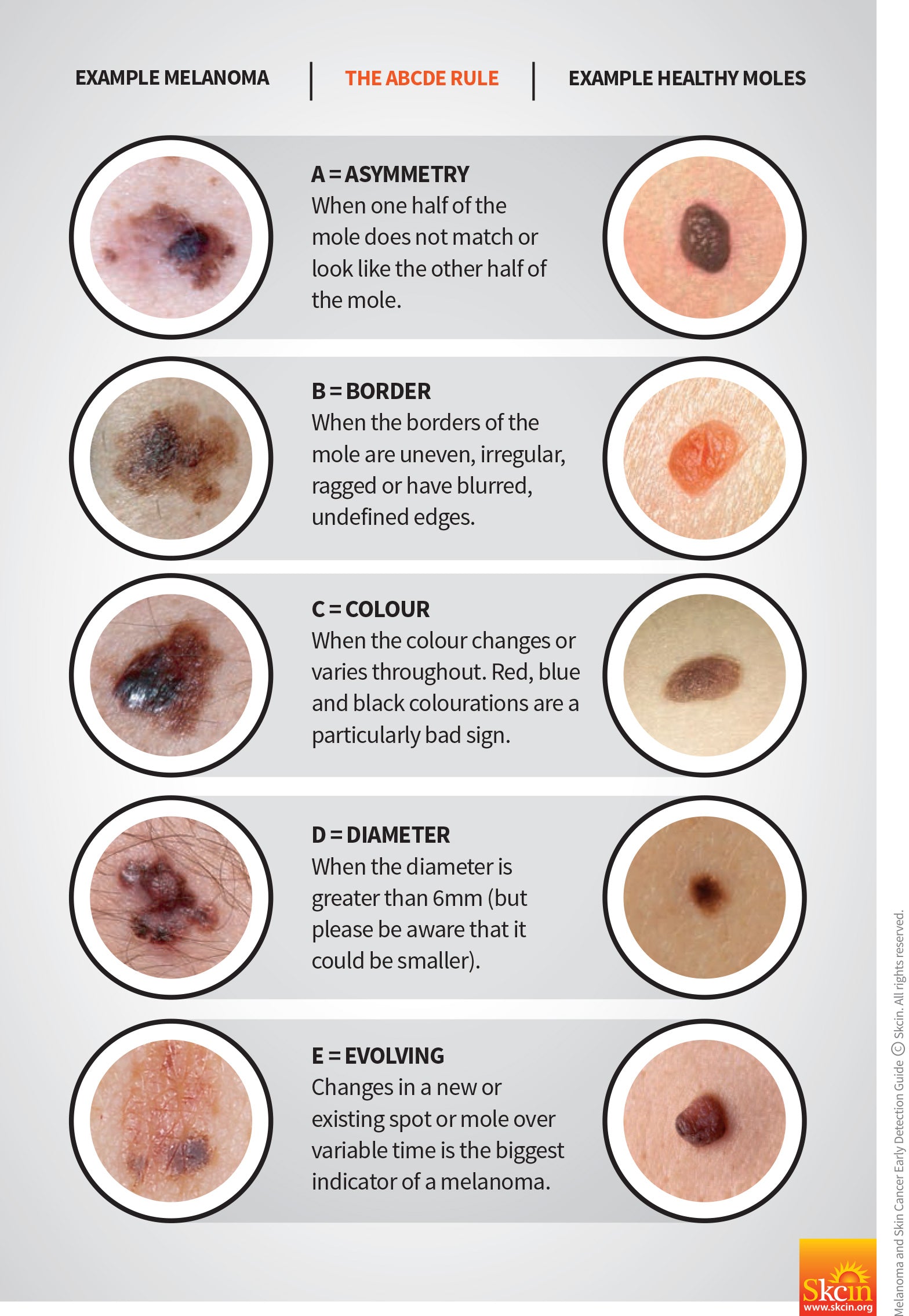 What Does Melanoma Look Like