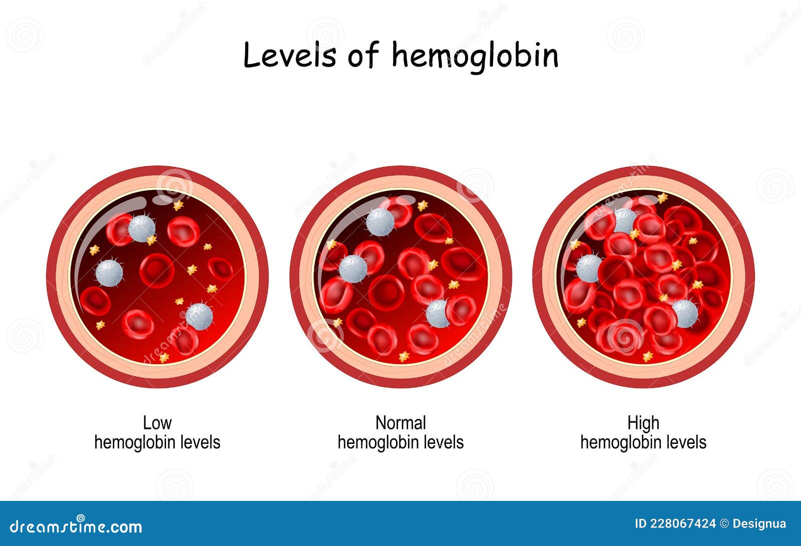 What Happens If Hemoglobin Is High