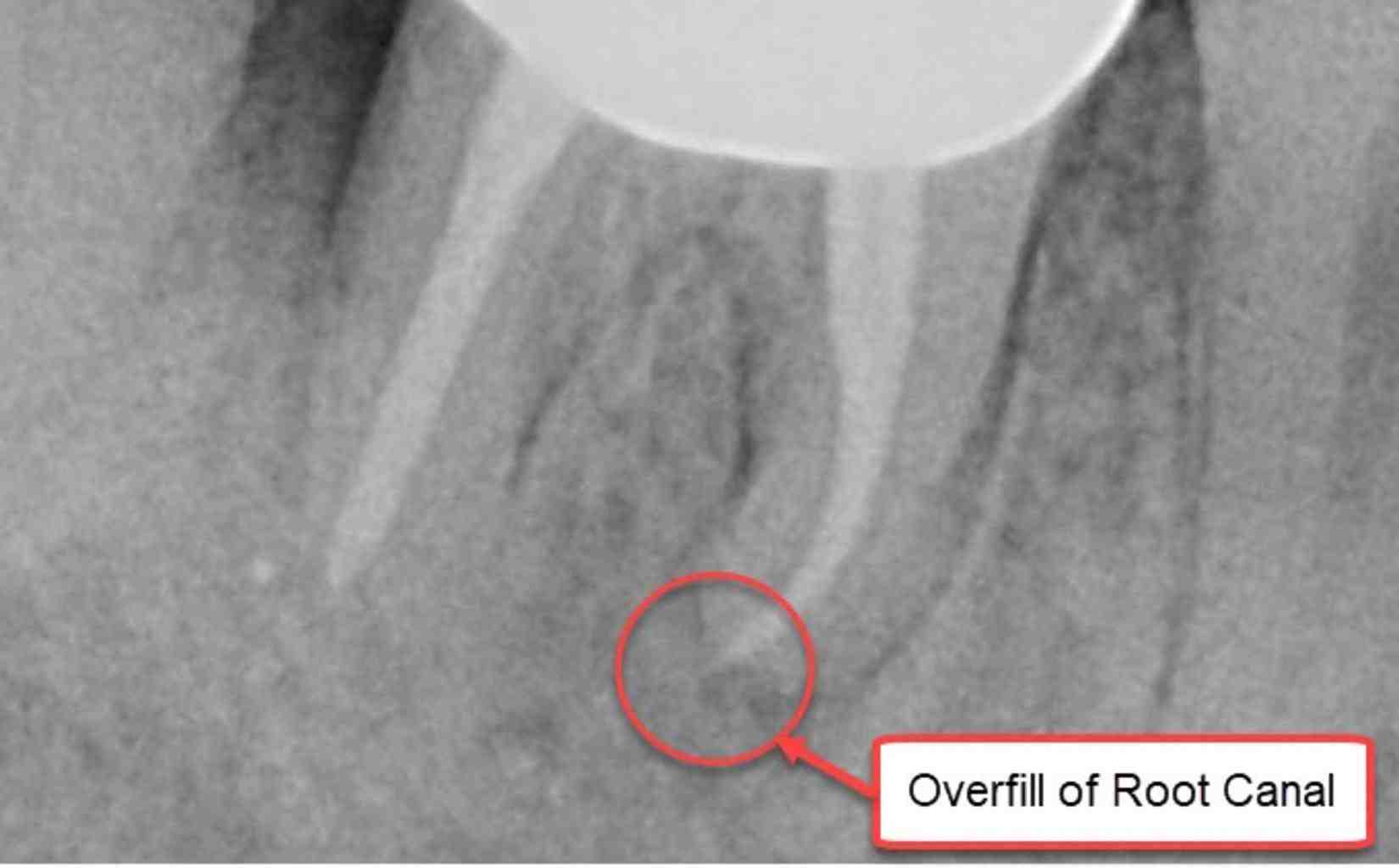 What Happens If Root Canal Fails
