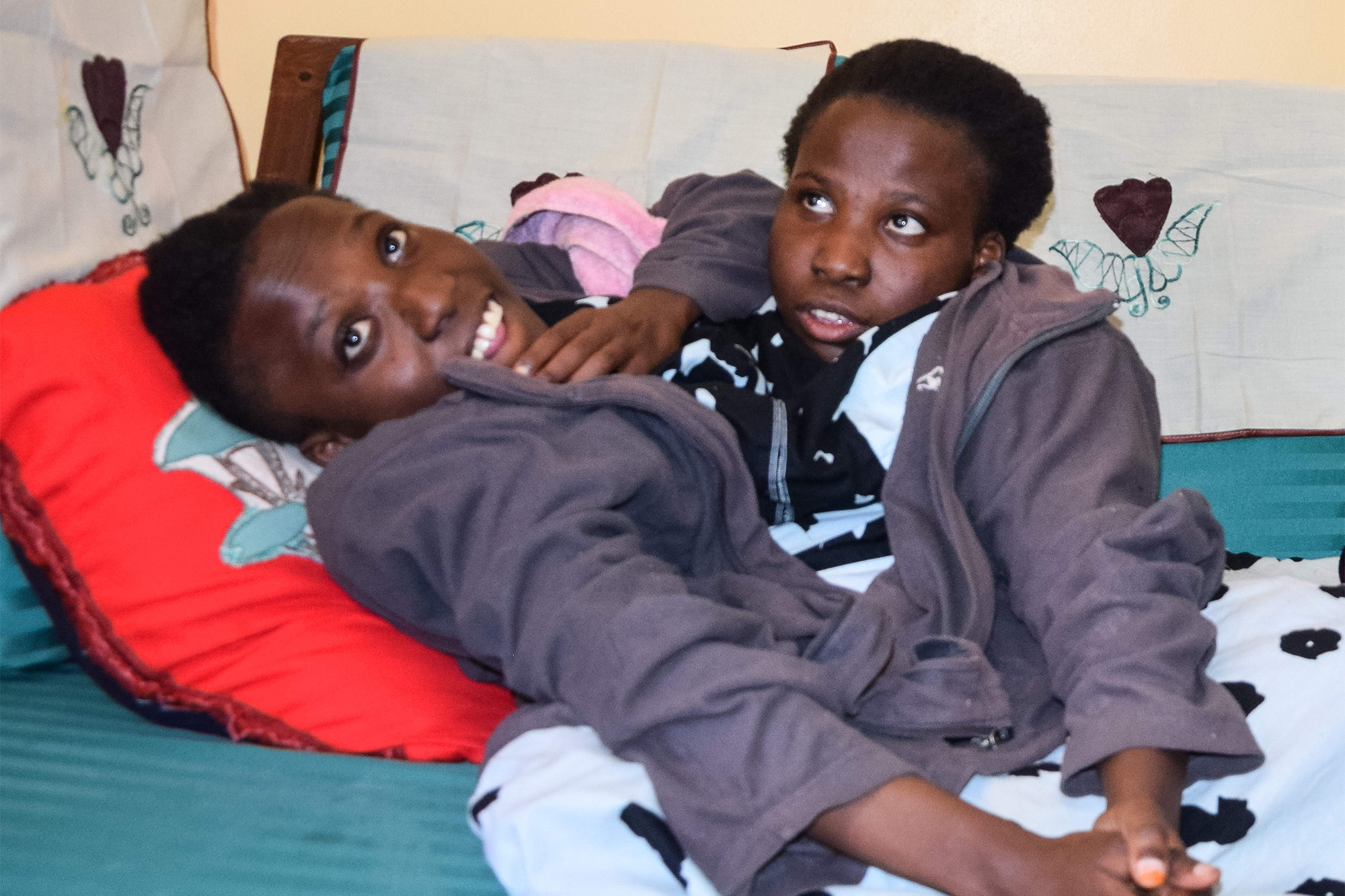 What Happens When Conjoined Twins Die