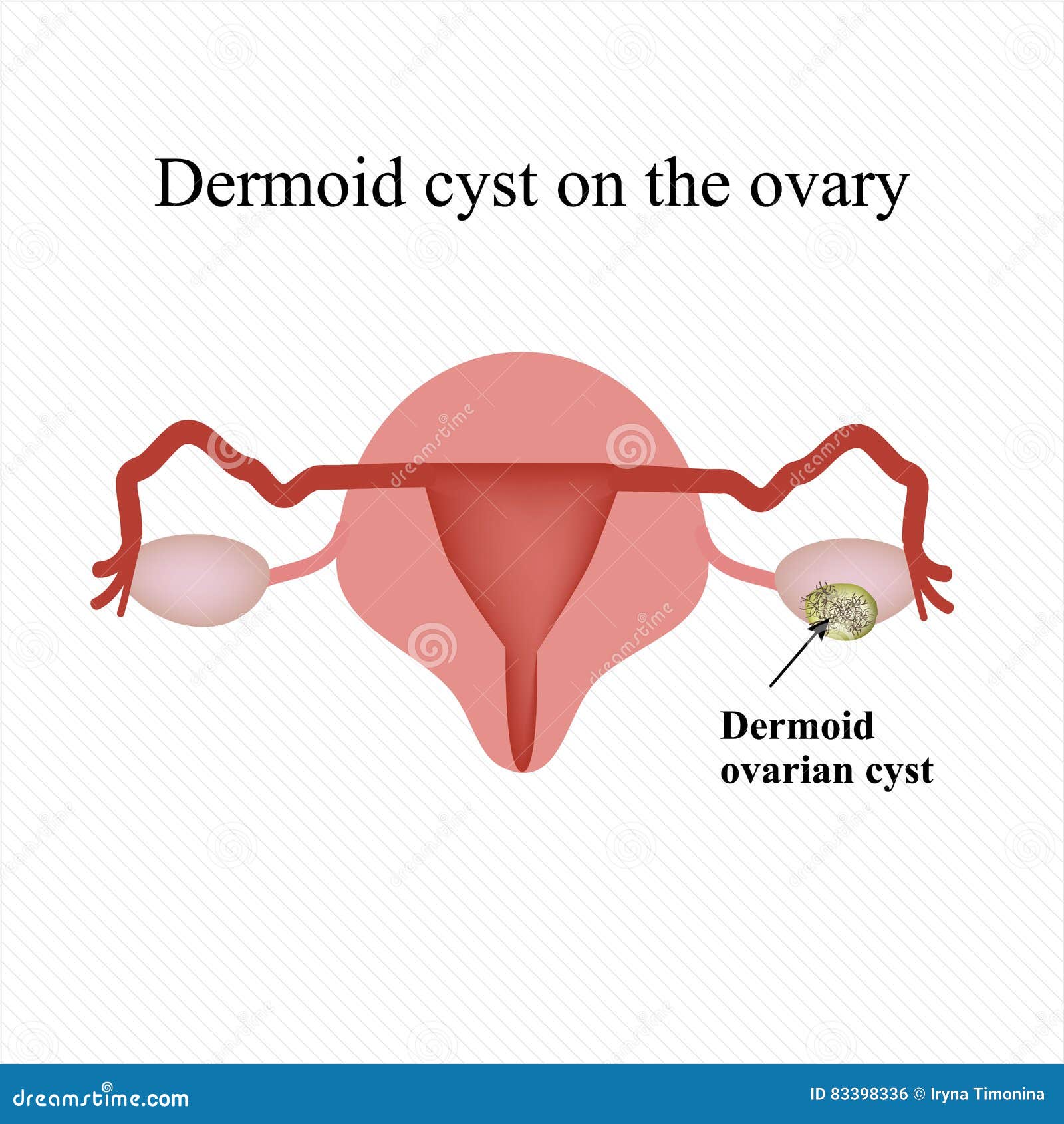 What Happens When Ovarian Cysts Burst
