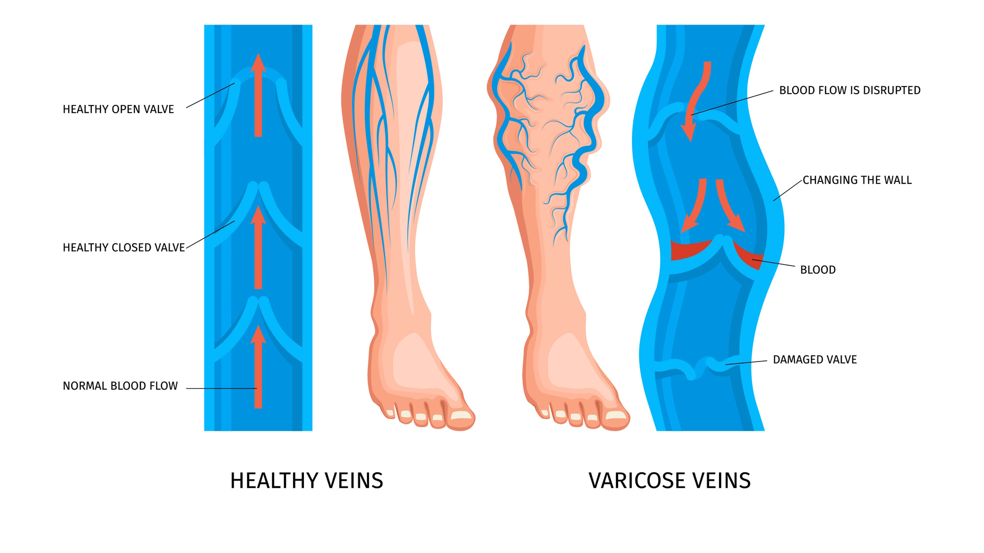 What Happens When Varicose Veins Rupture