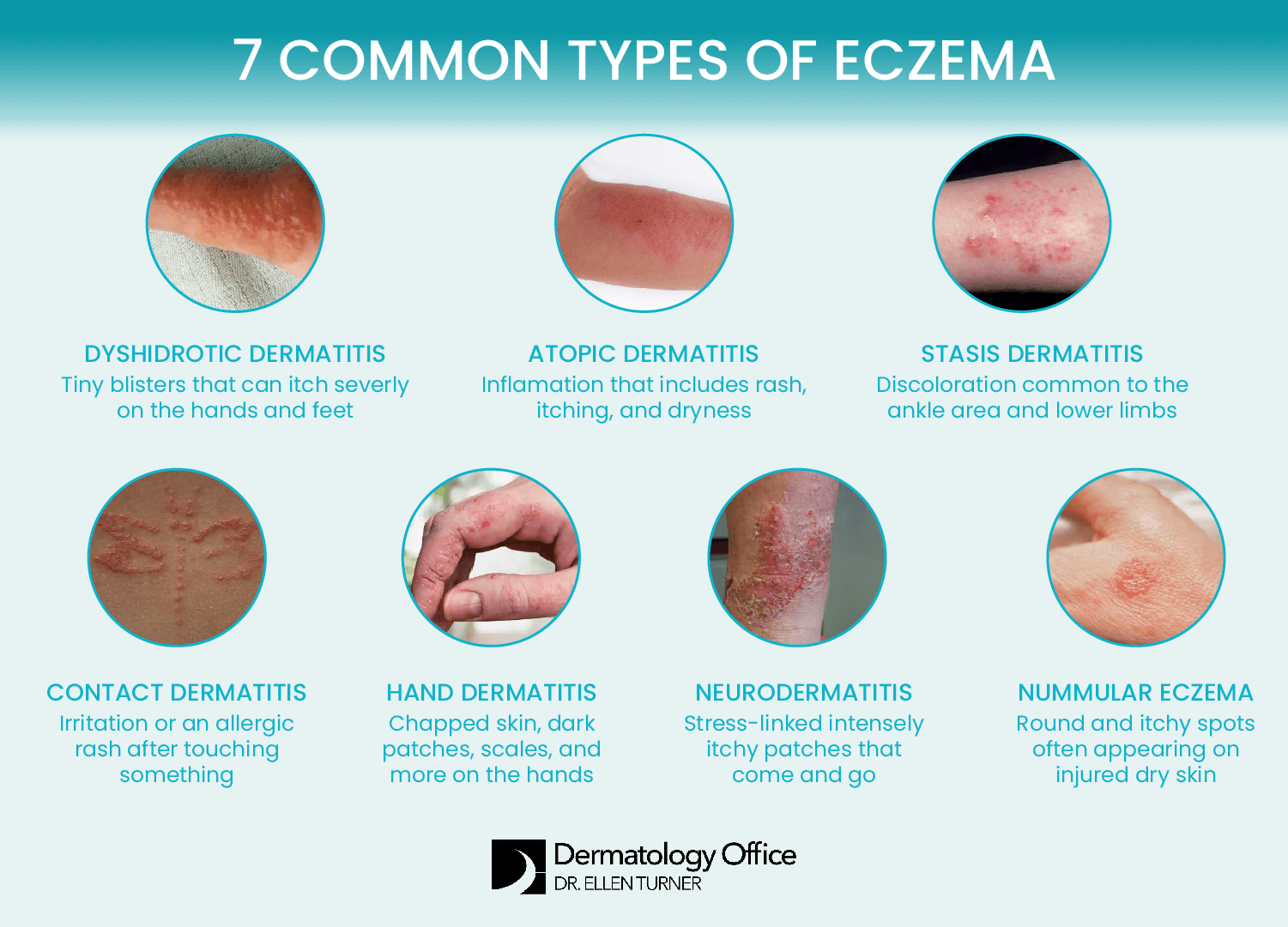 What Helps With Eczema