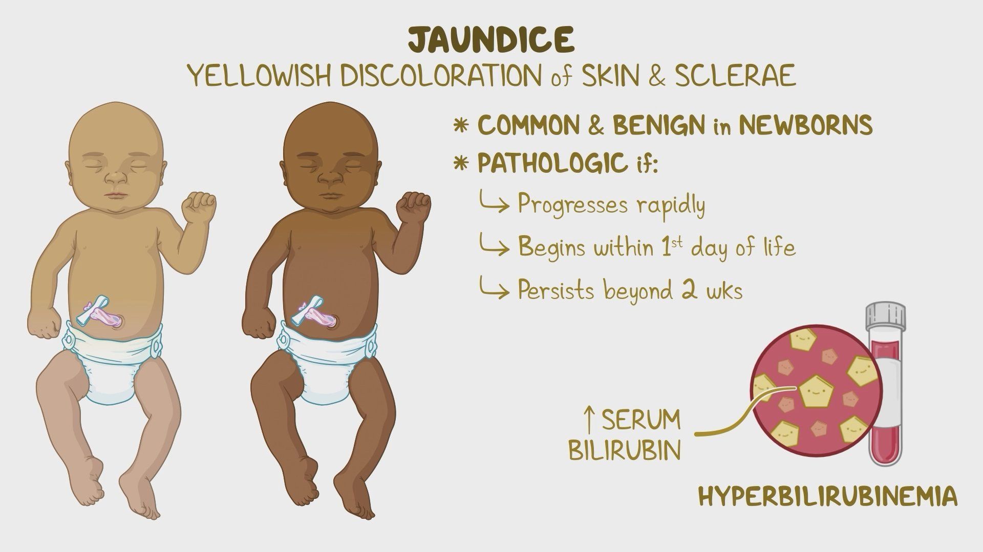 What Increases Jaundice In Newborn