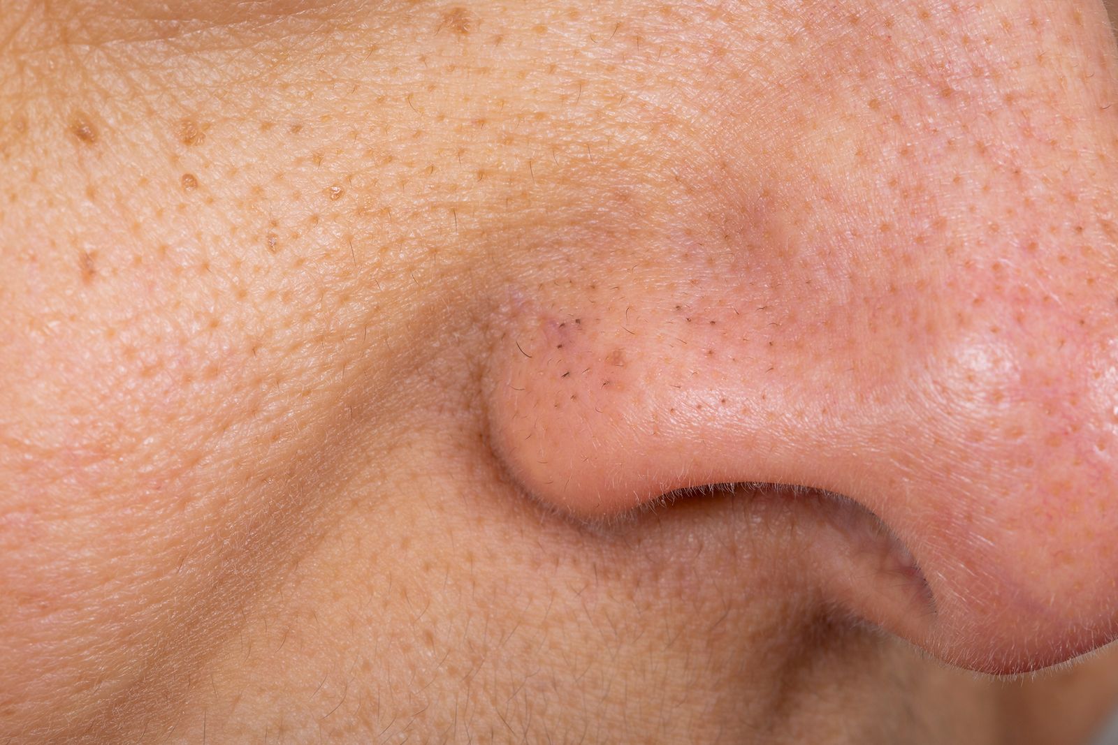 What Is A Blackhead