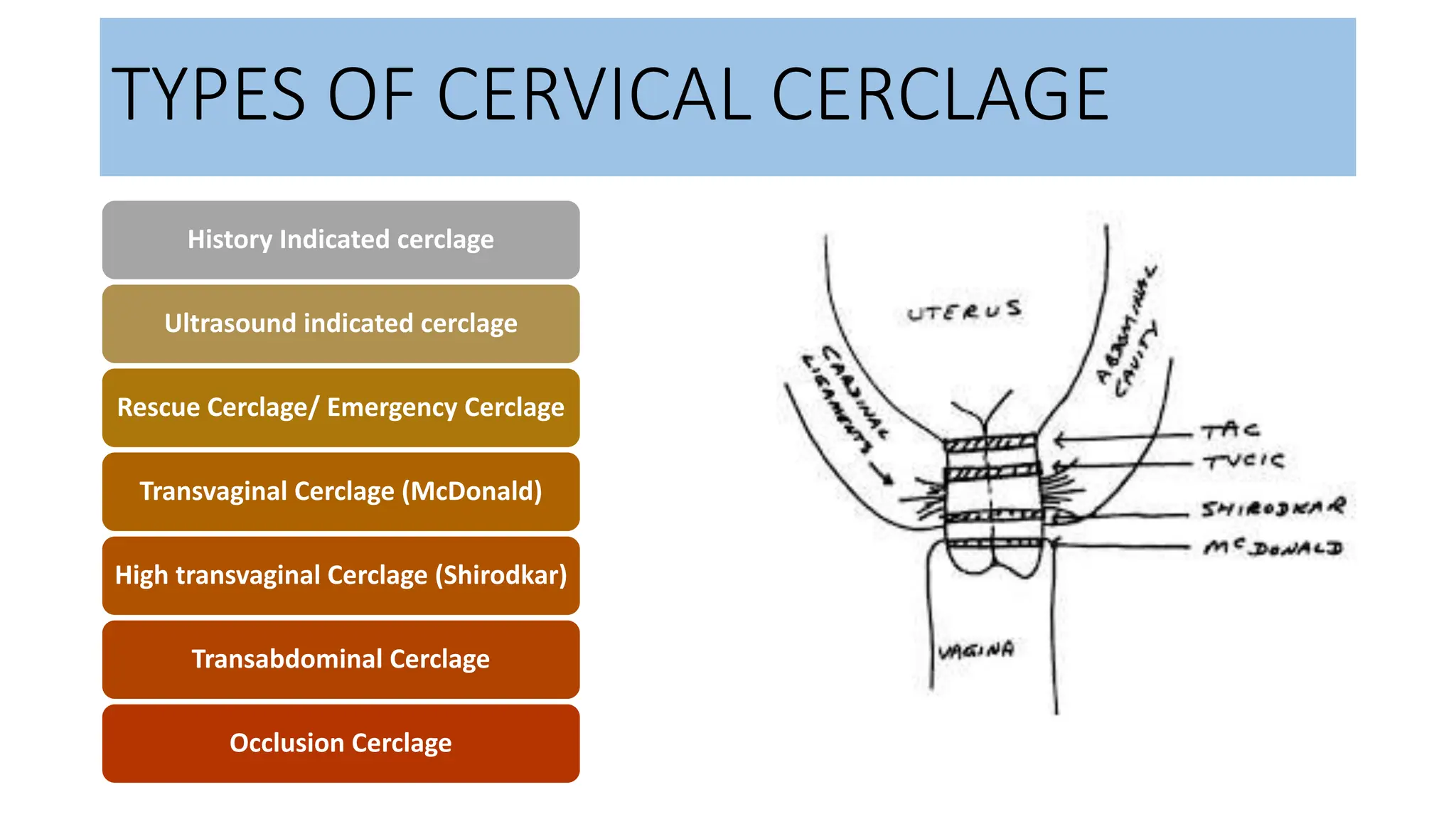 What Is A Cerclage