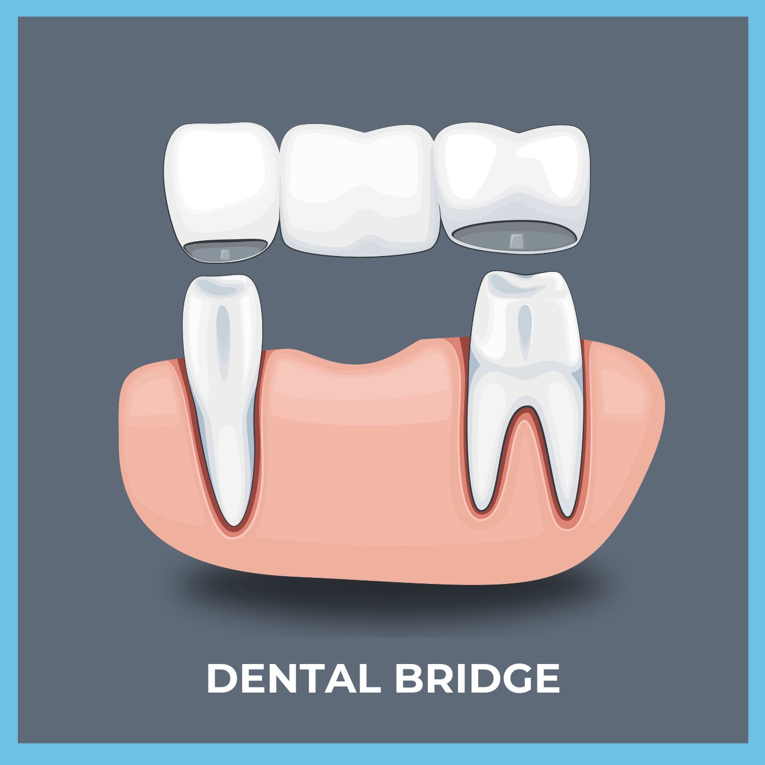 What Is A Dental Bridge