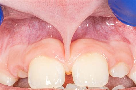 What Is A Frenectomy