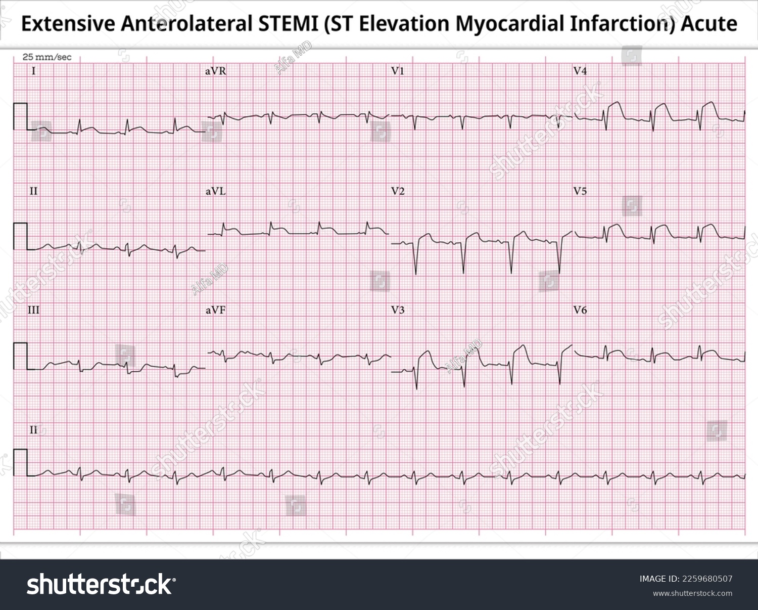 What Is A Stemi