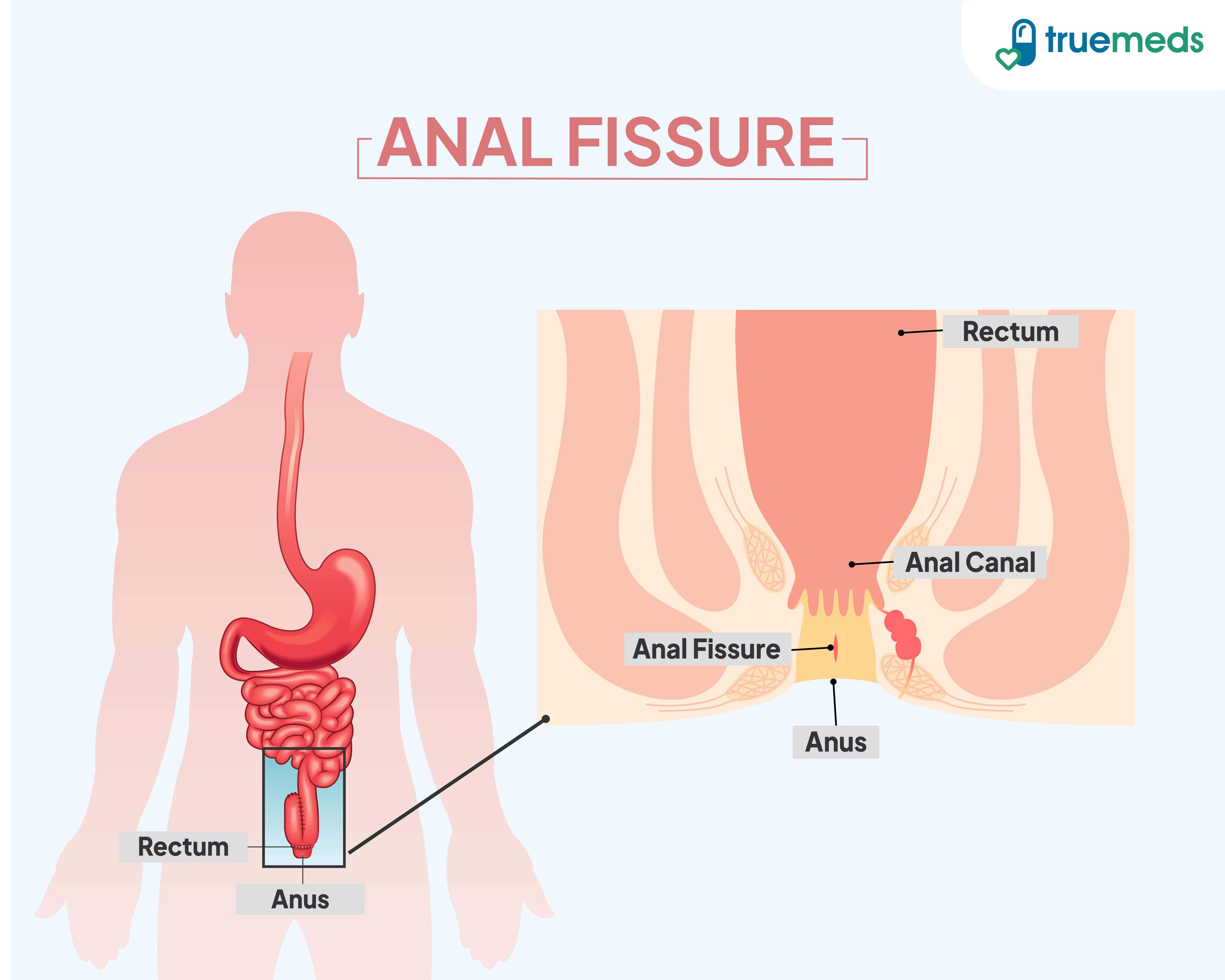 What Is An Anal Fissure