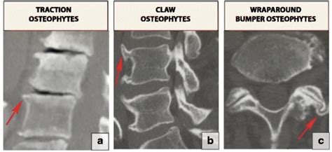 What Is An Osteophyte