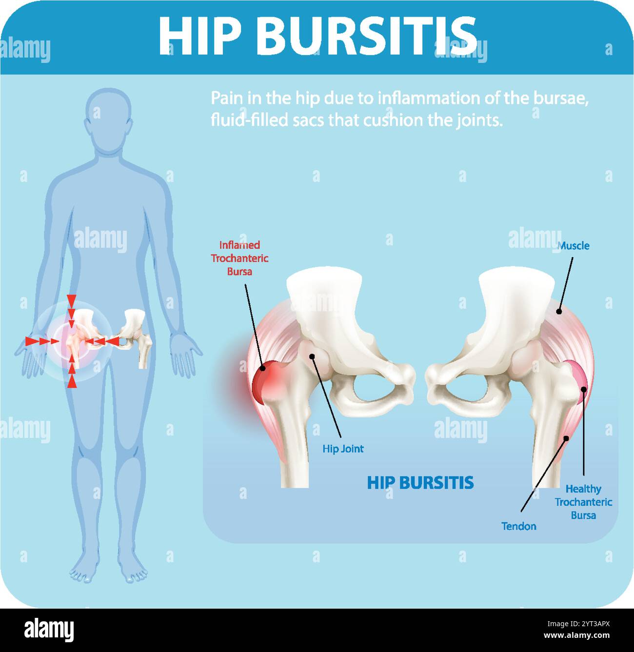 What Is Bursitis Hip
