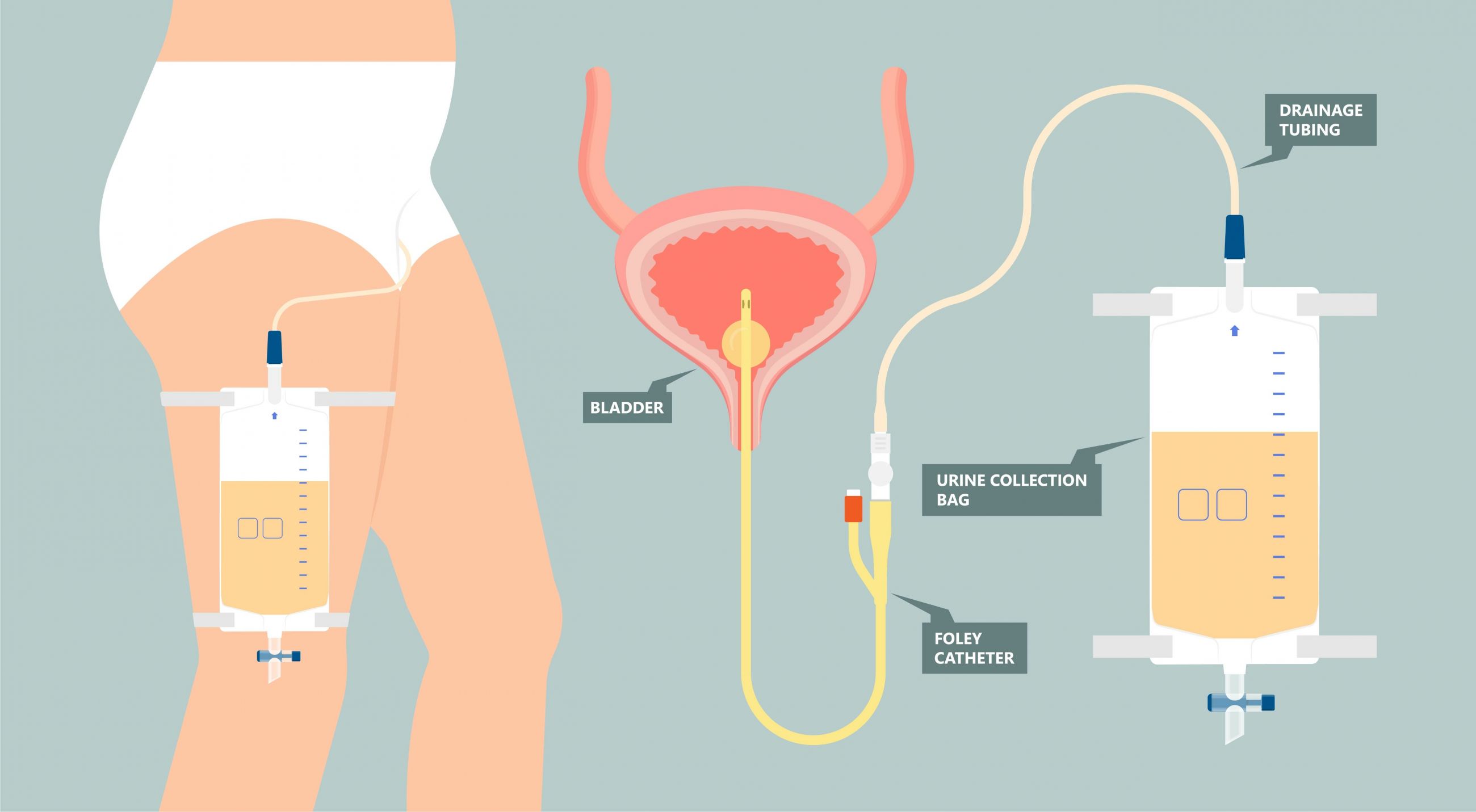 What Is Catheter