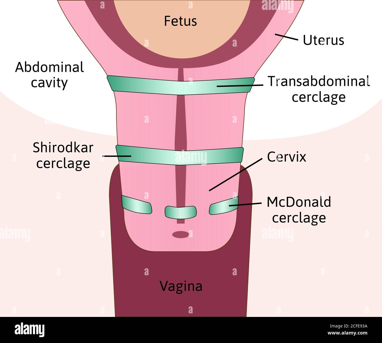 What Is Cervix Cerclage
