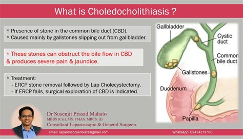 What Is Choledocholithiasis
