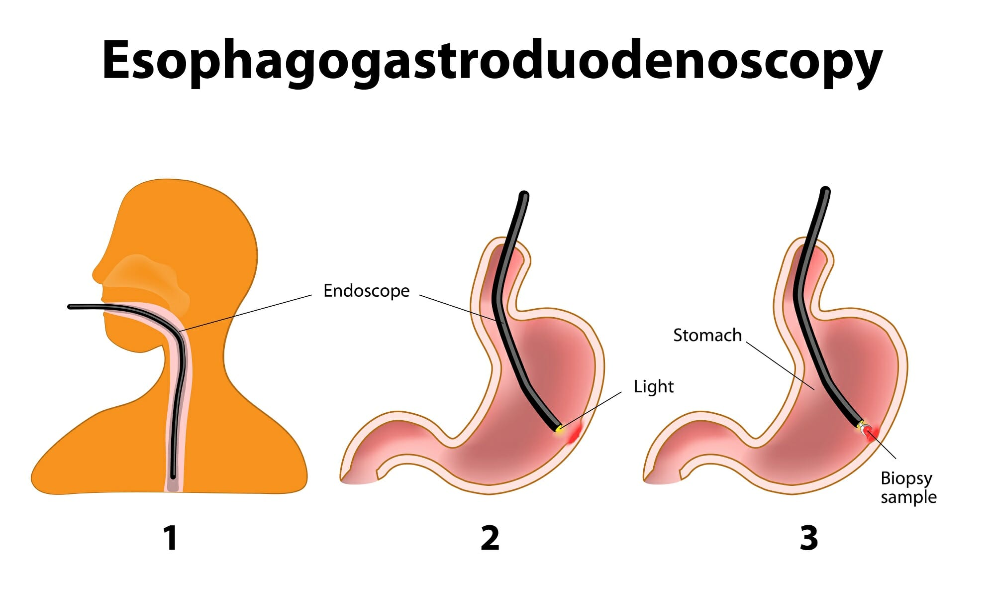 What Is Egd