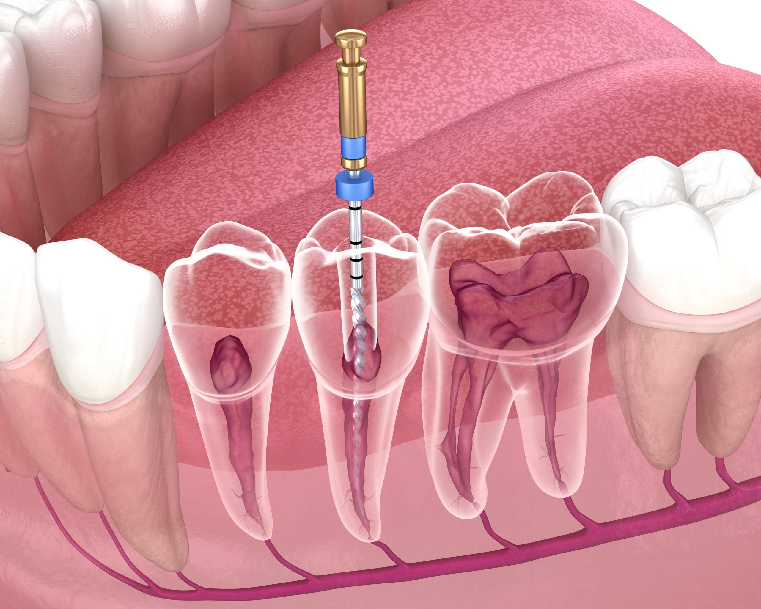 What Is Endodontics