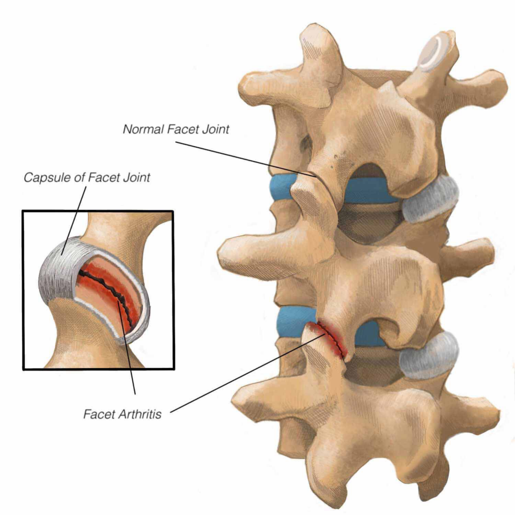 What Is Facet Arthropathy