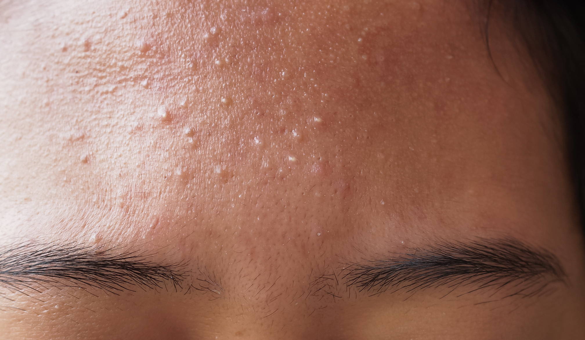 What Is Fungal Acne